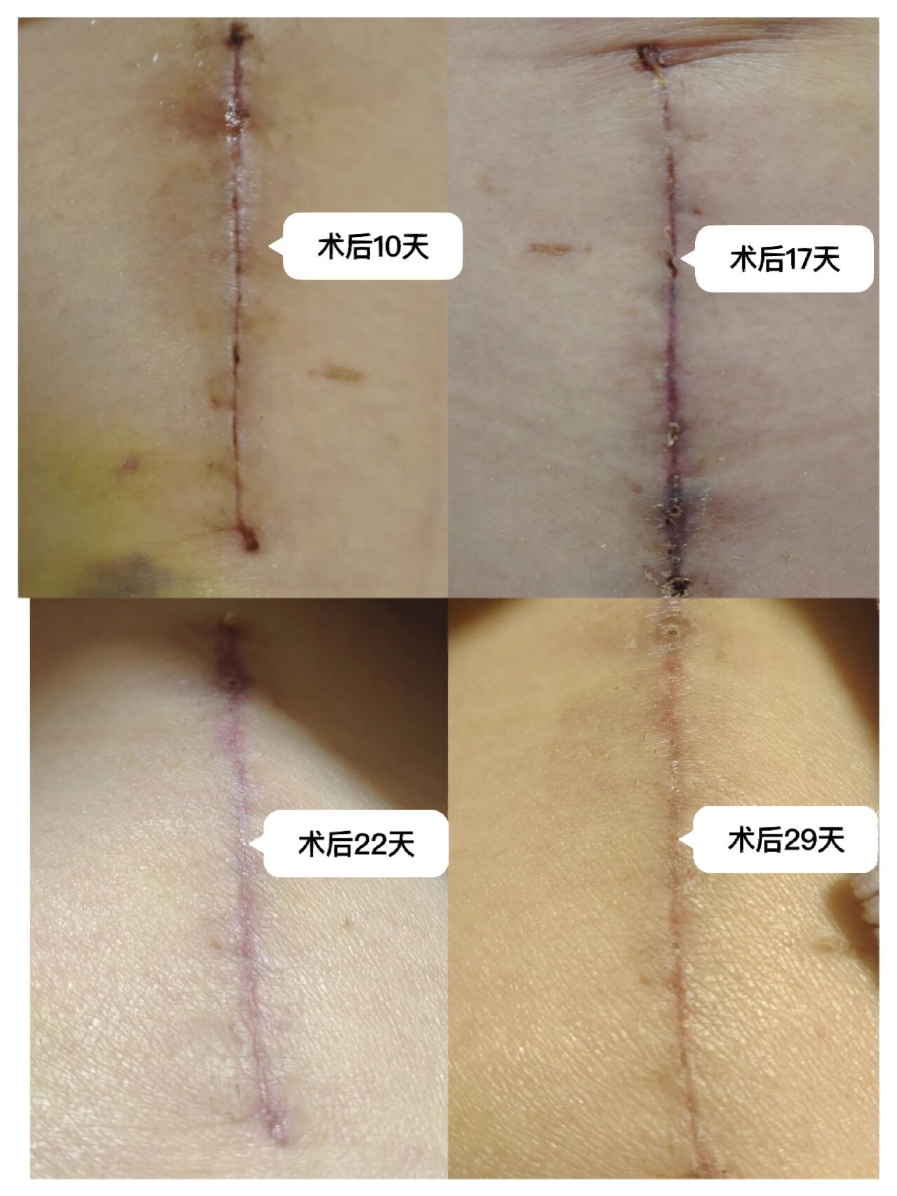 开腹手术切口一月变化