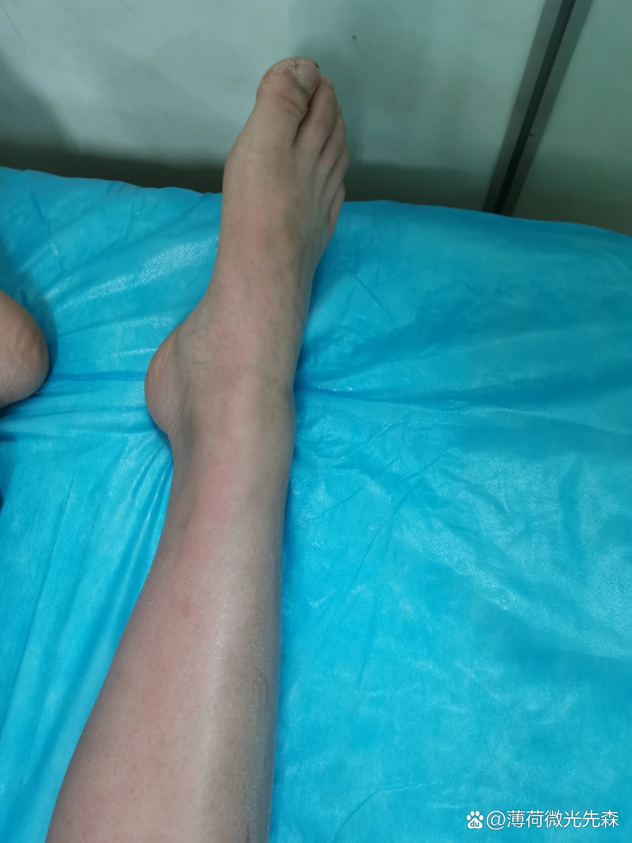 分享病例:腓总神经损伤之足下垂