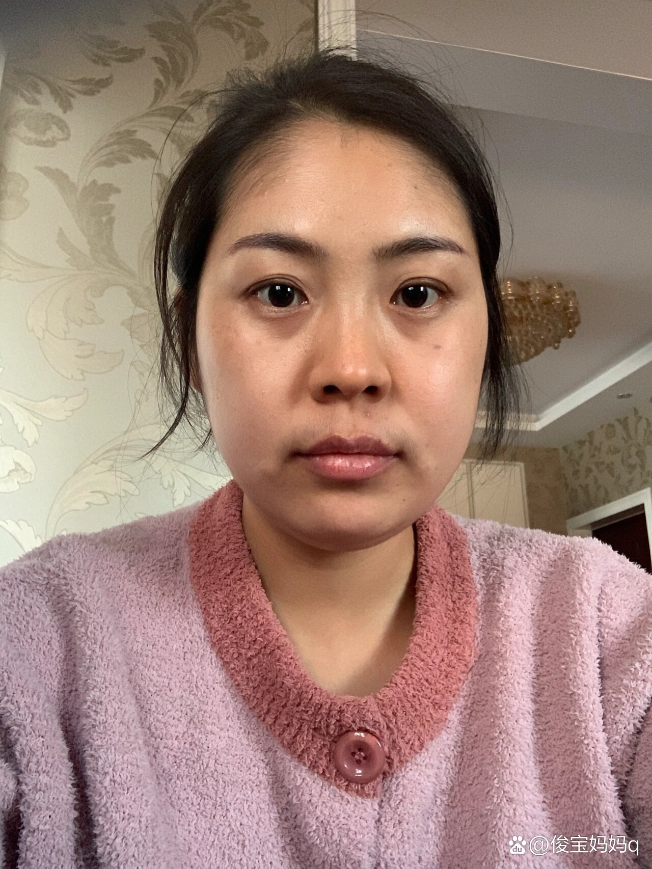 满月脸一点都没有消退.期间胖了十斤左右!姨妈紊乱!