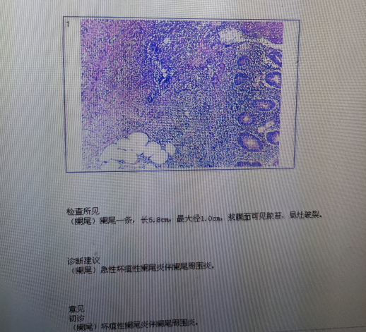 急性阑尾炎病理生理图图片