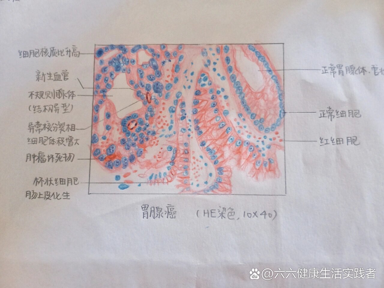胃腺癌