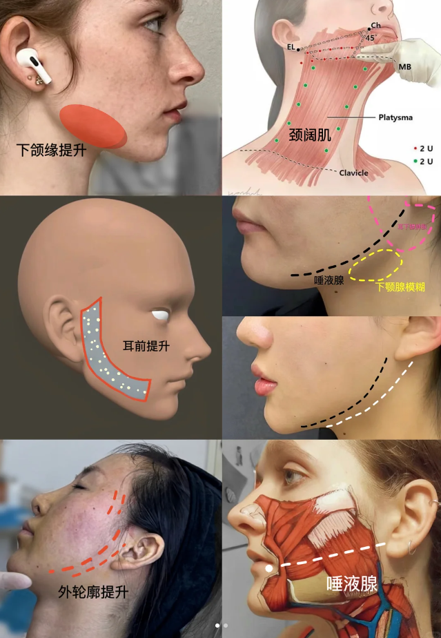 肉毒素提升下颌缘打法图片