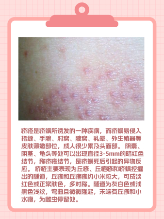 疥疮长什么样子,你真的了解吗?