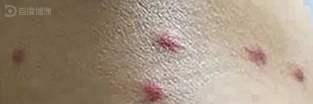 结节性痒疹该如何治疗-医疗科普-百度健康