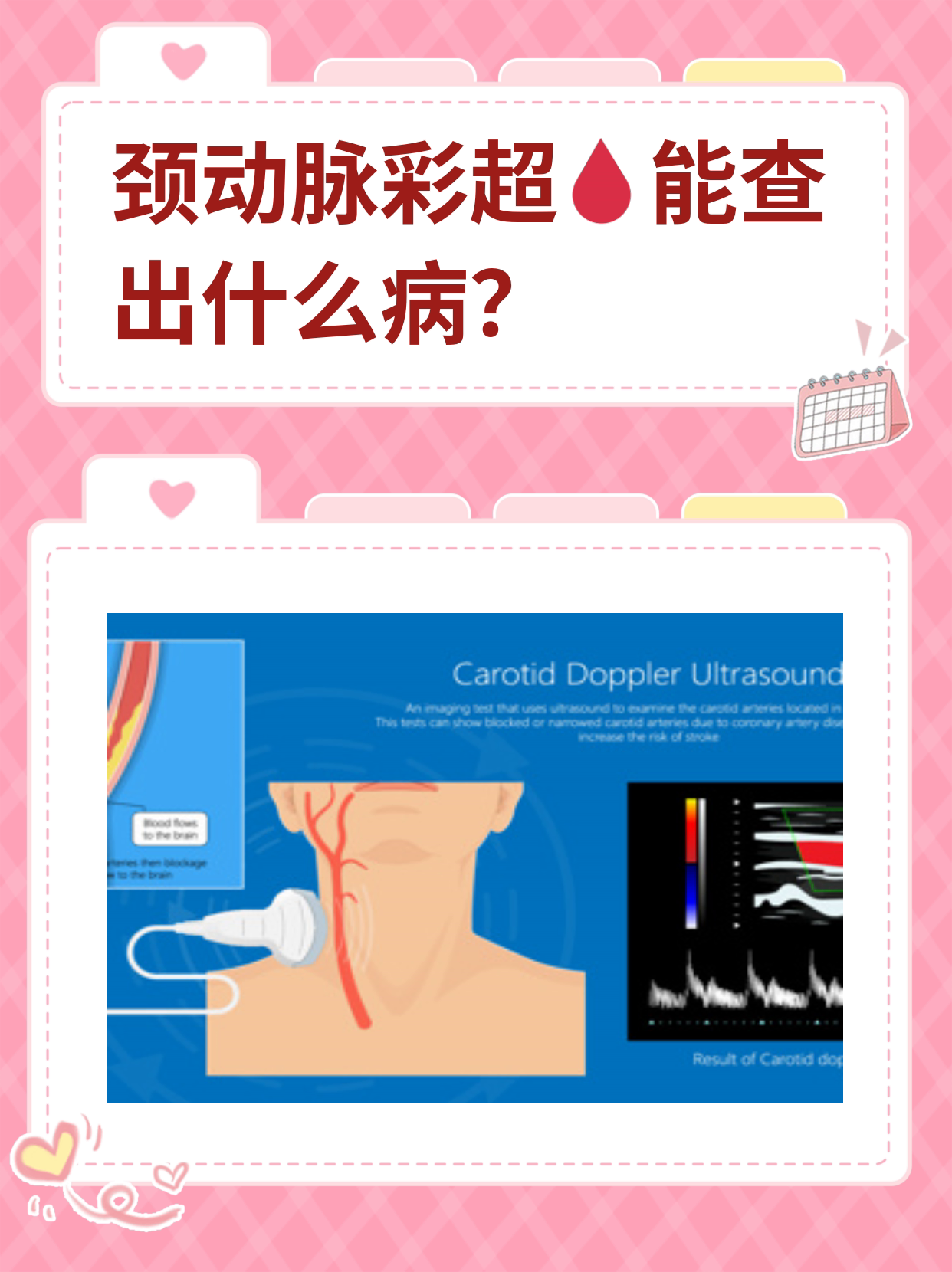 颈动脉彩超能查出什么病呢