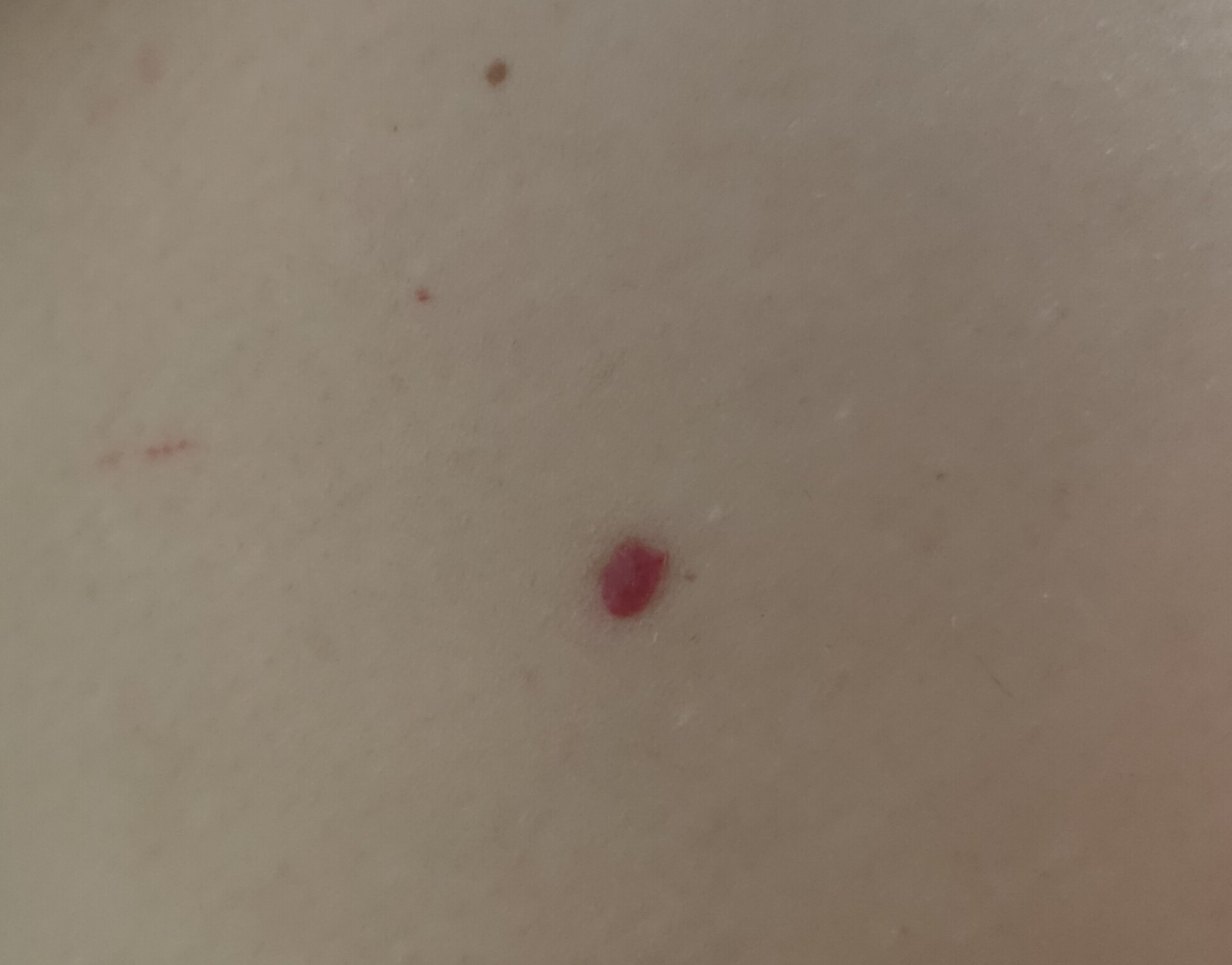 身体上出现这种小红点是什么情况?