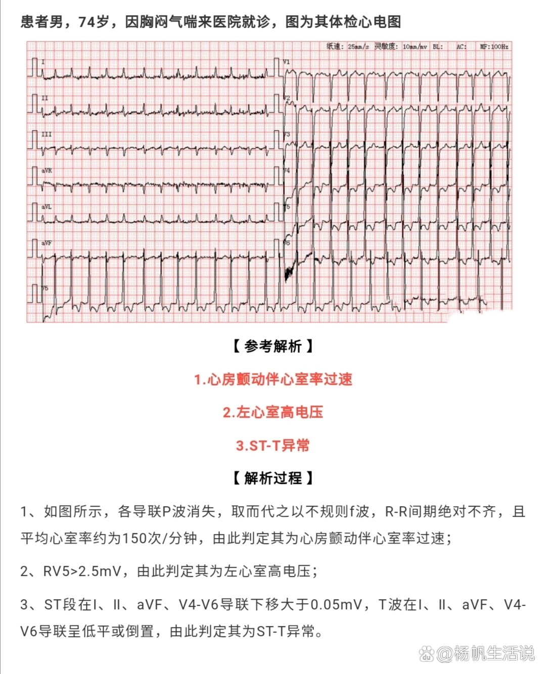 心电图电压图片