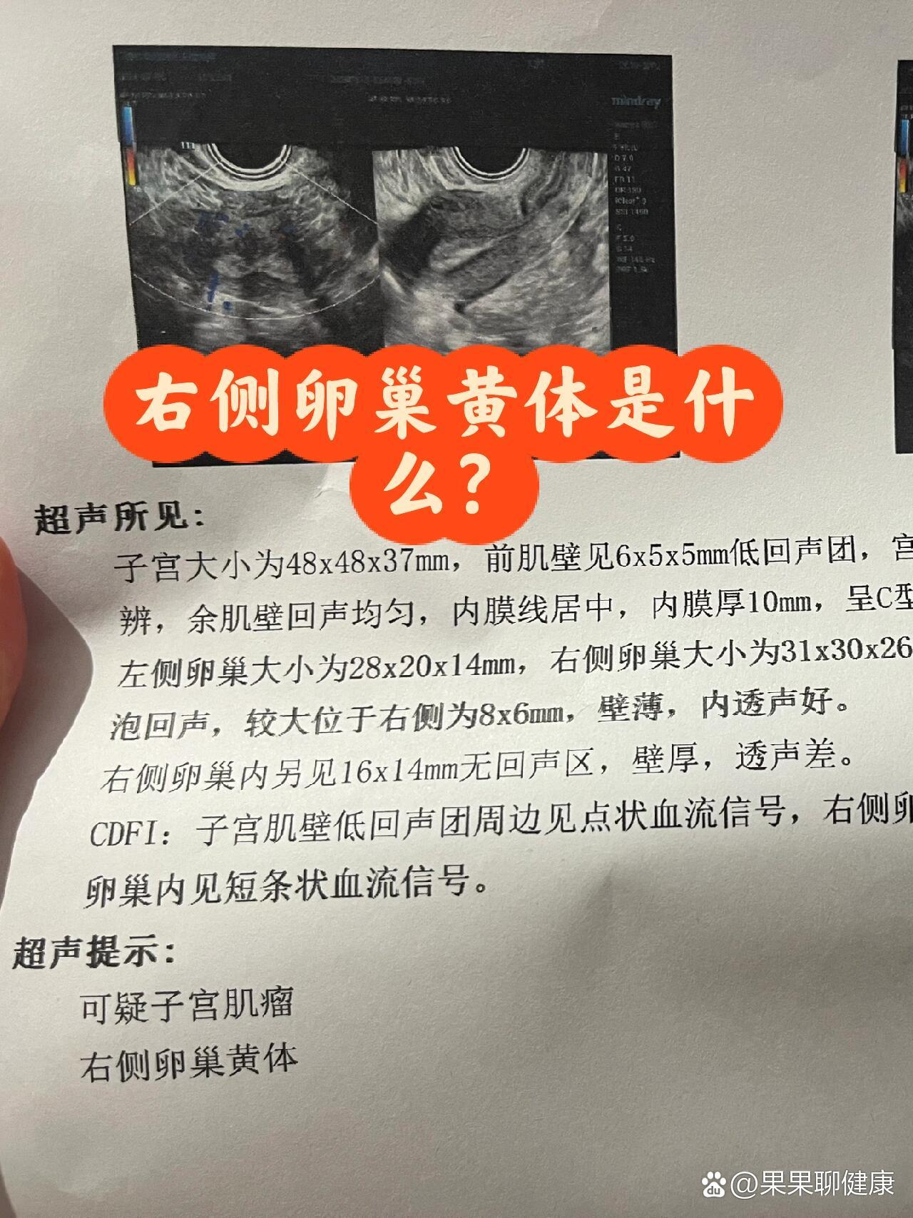 右侧卵巢内另见无回声区是什么?