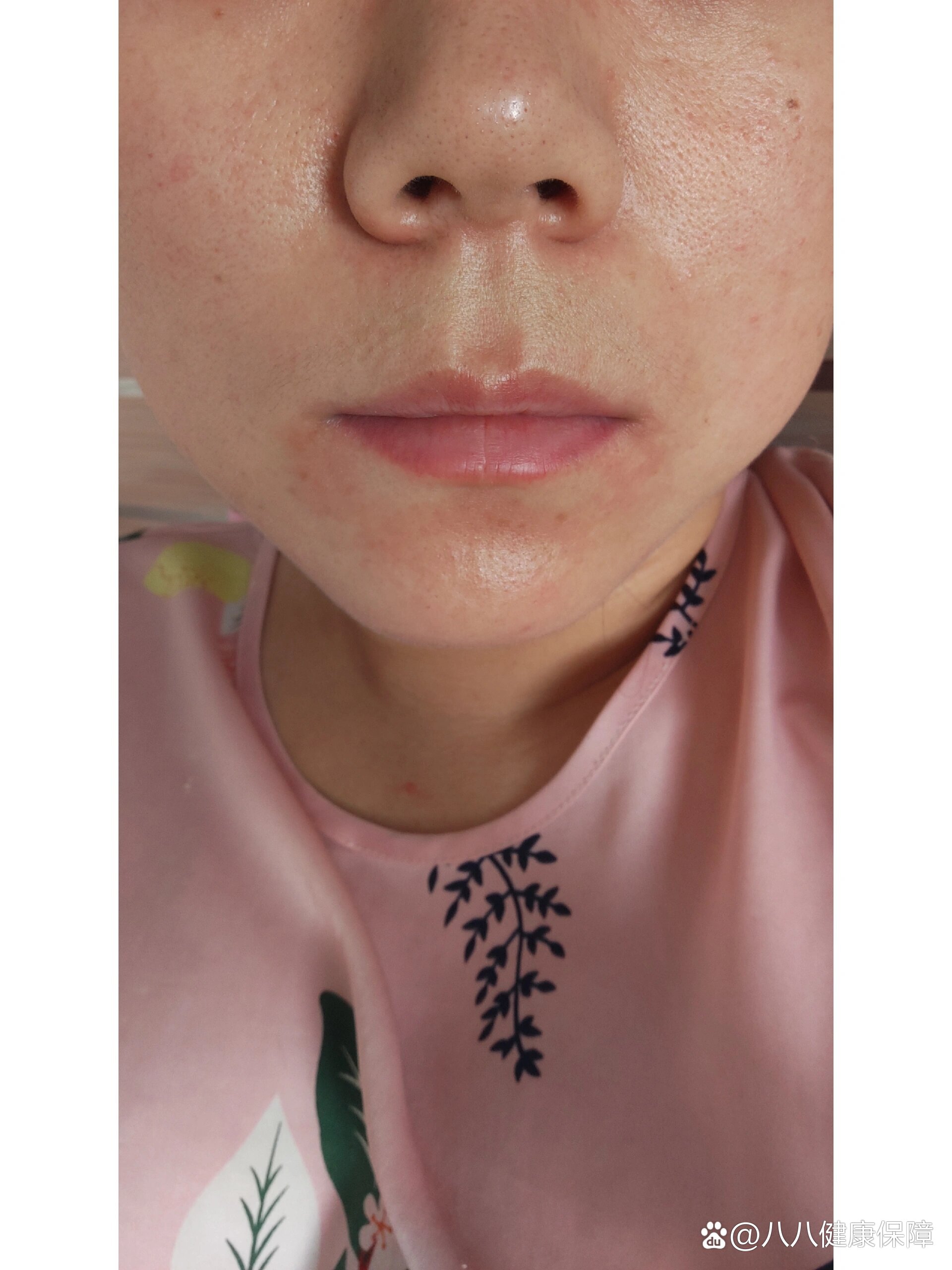 孕期嘴周围发红,过敏,皮肤差