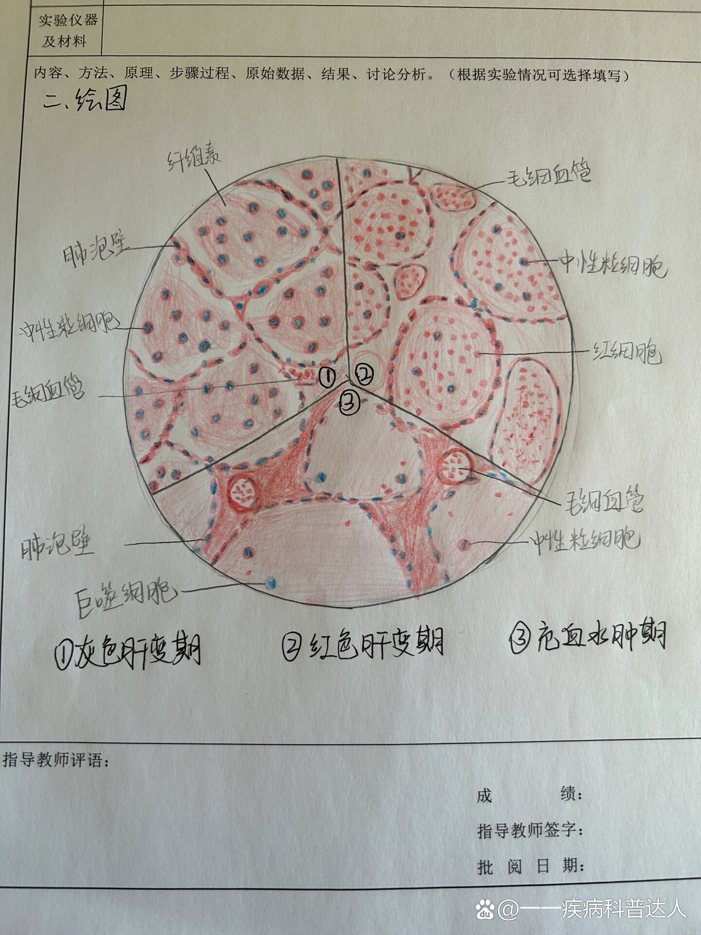 肺脓肿病理切片手绘图图片