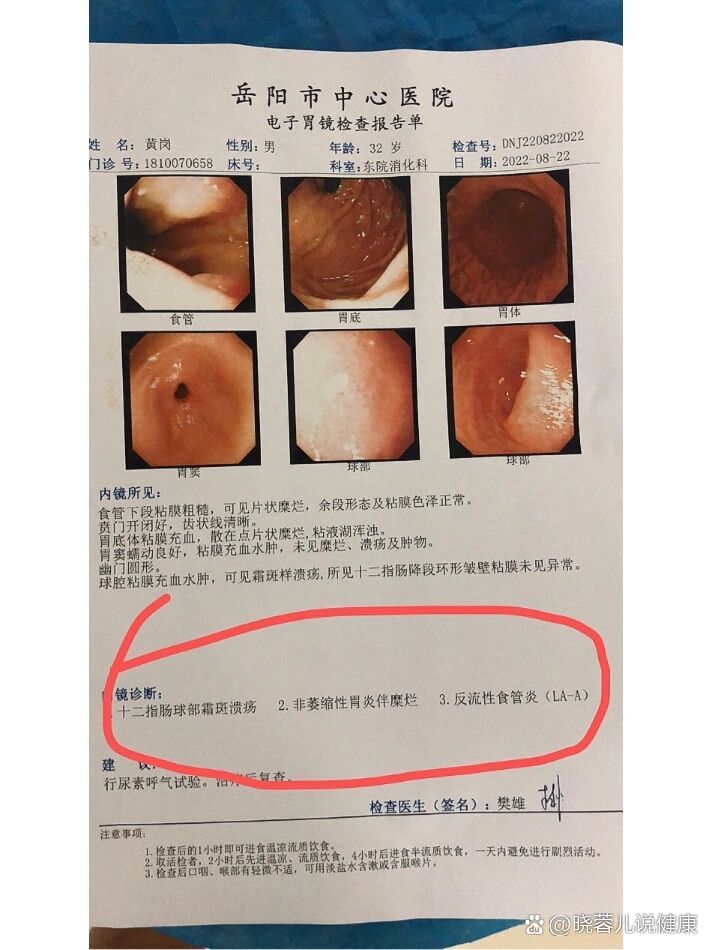 非萎缩性胃炎伴糜烂,十二脂肠球部霜斑溃疡