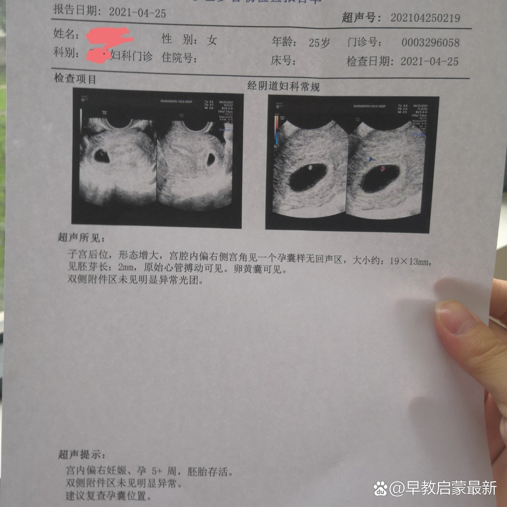 怀孕20天的孕囊图片图片