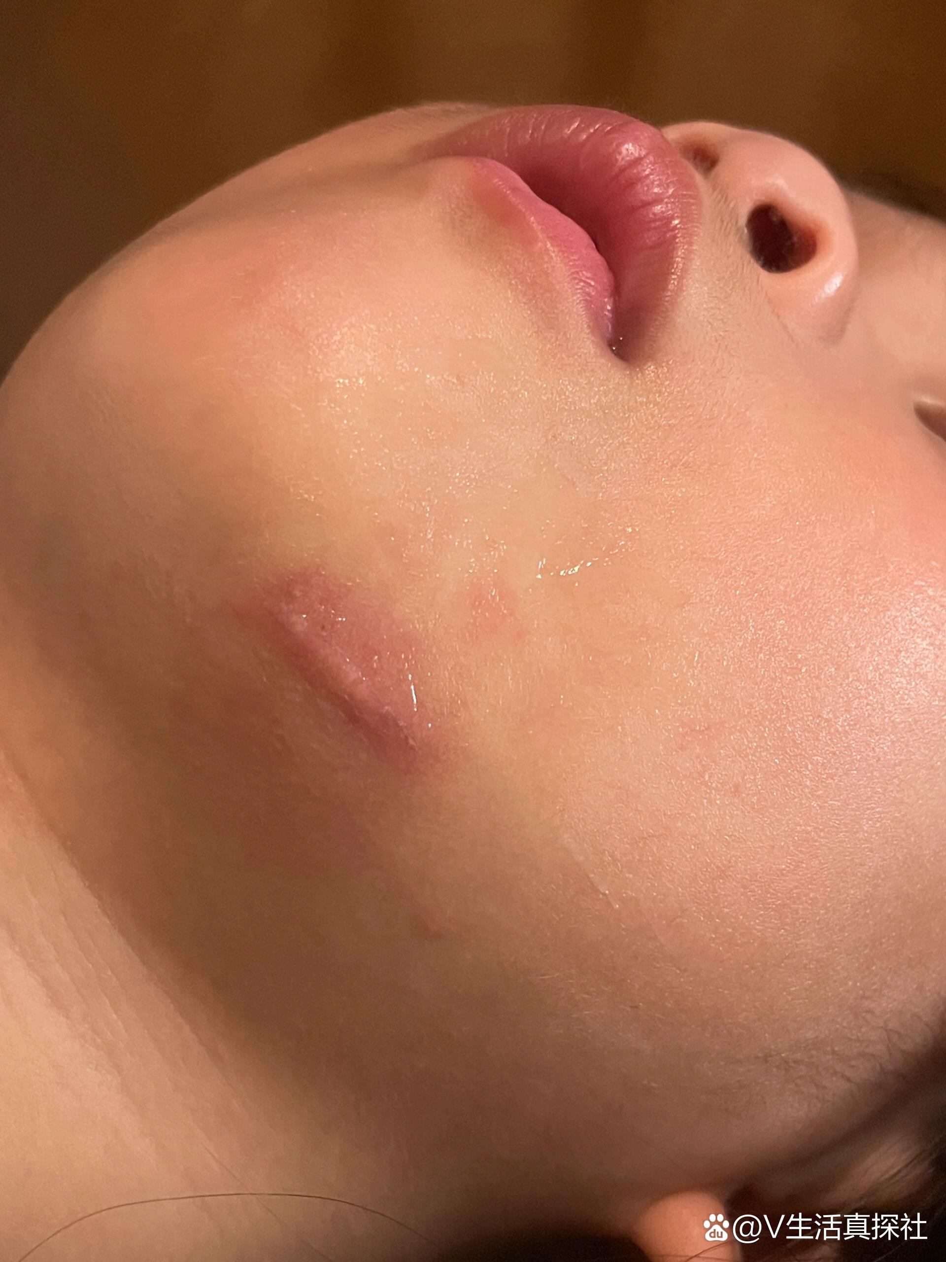  p>拆线第三天 br>凸起还是有 摸去硬硬的 不确定是不是美容线没有