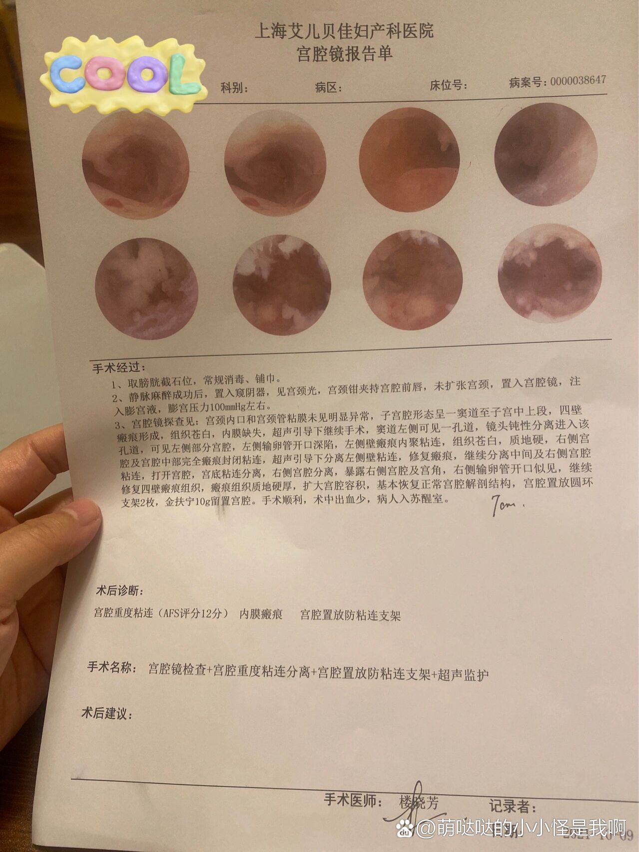 重度宫腔粘连