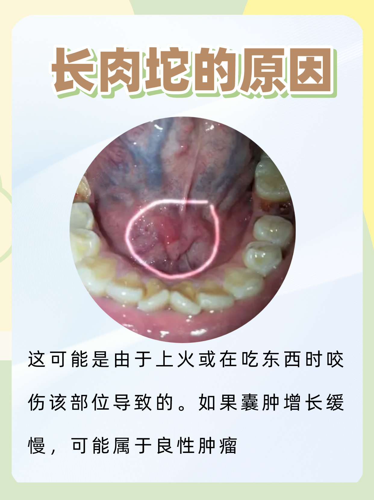 舌下腺脂肪瘤图片