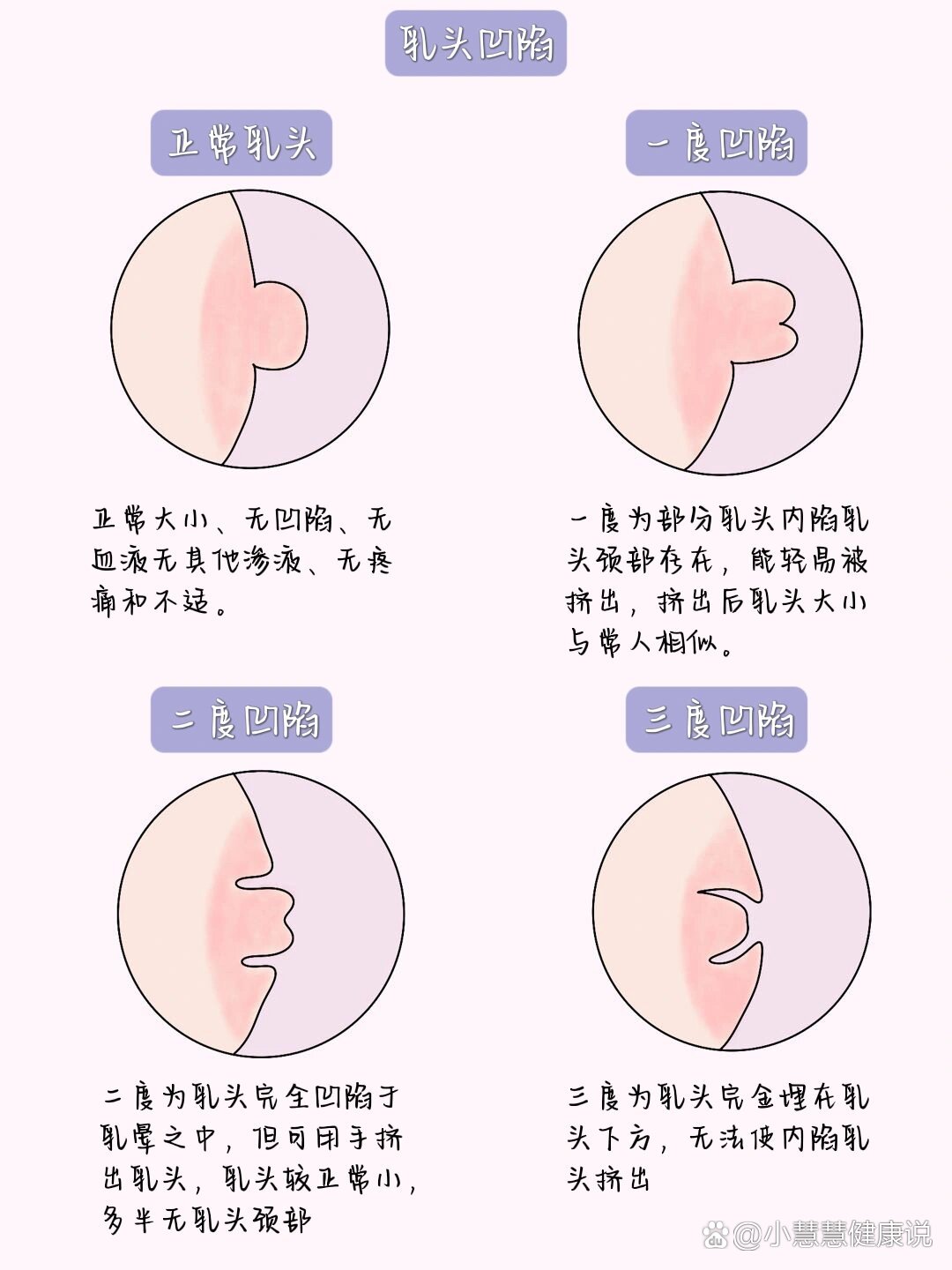 医学生笔记7199(妇科篇)/乳头内陷