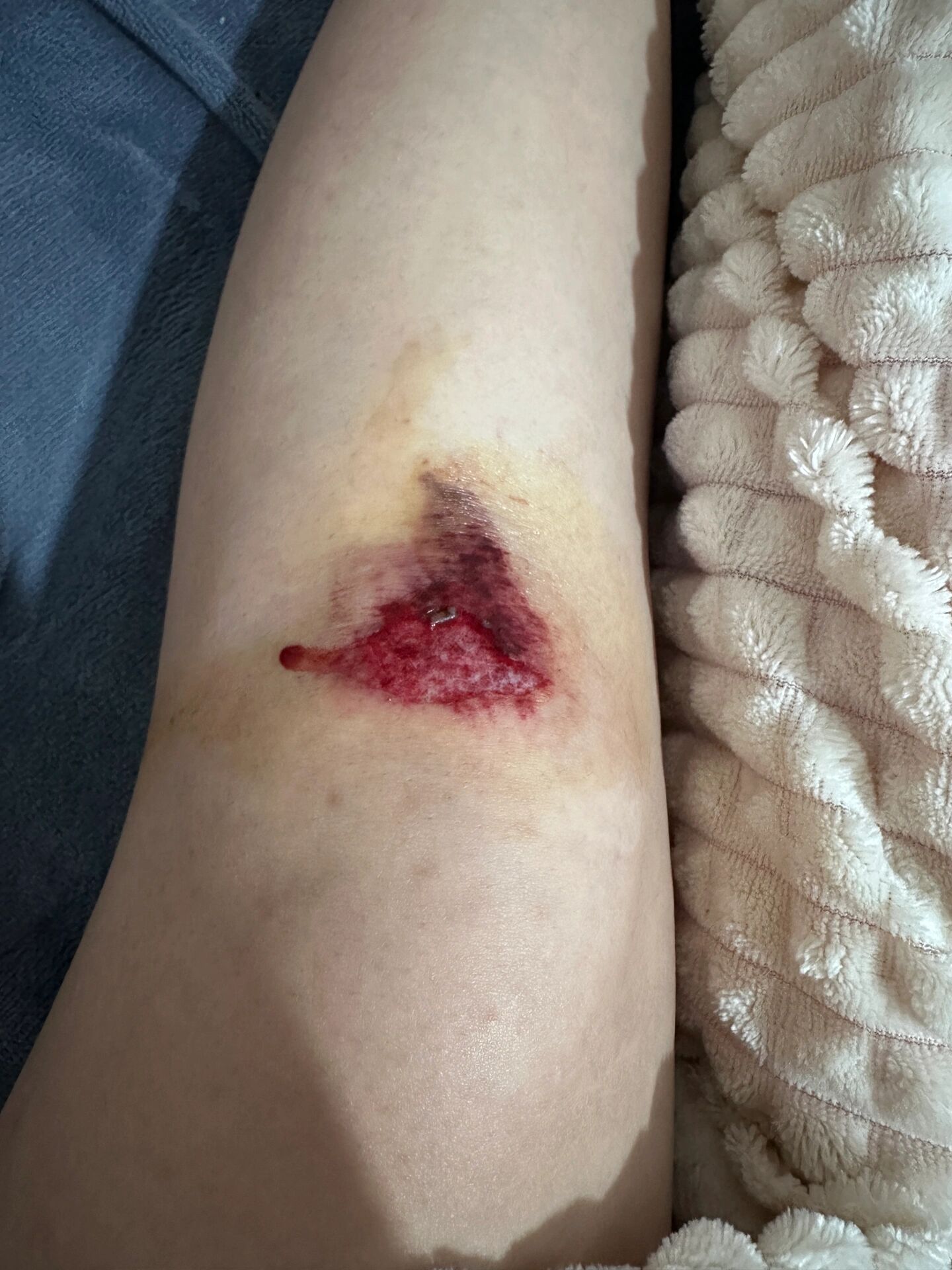 膝盖摔伤怎么愈合伤口较快