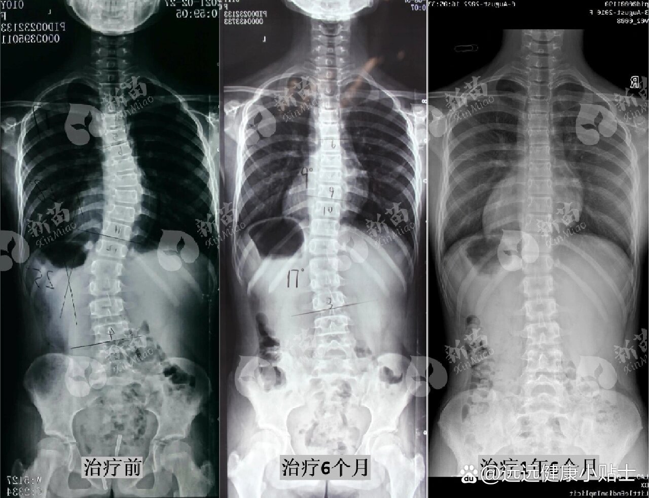 正常人体脊椎x光片图片