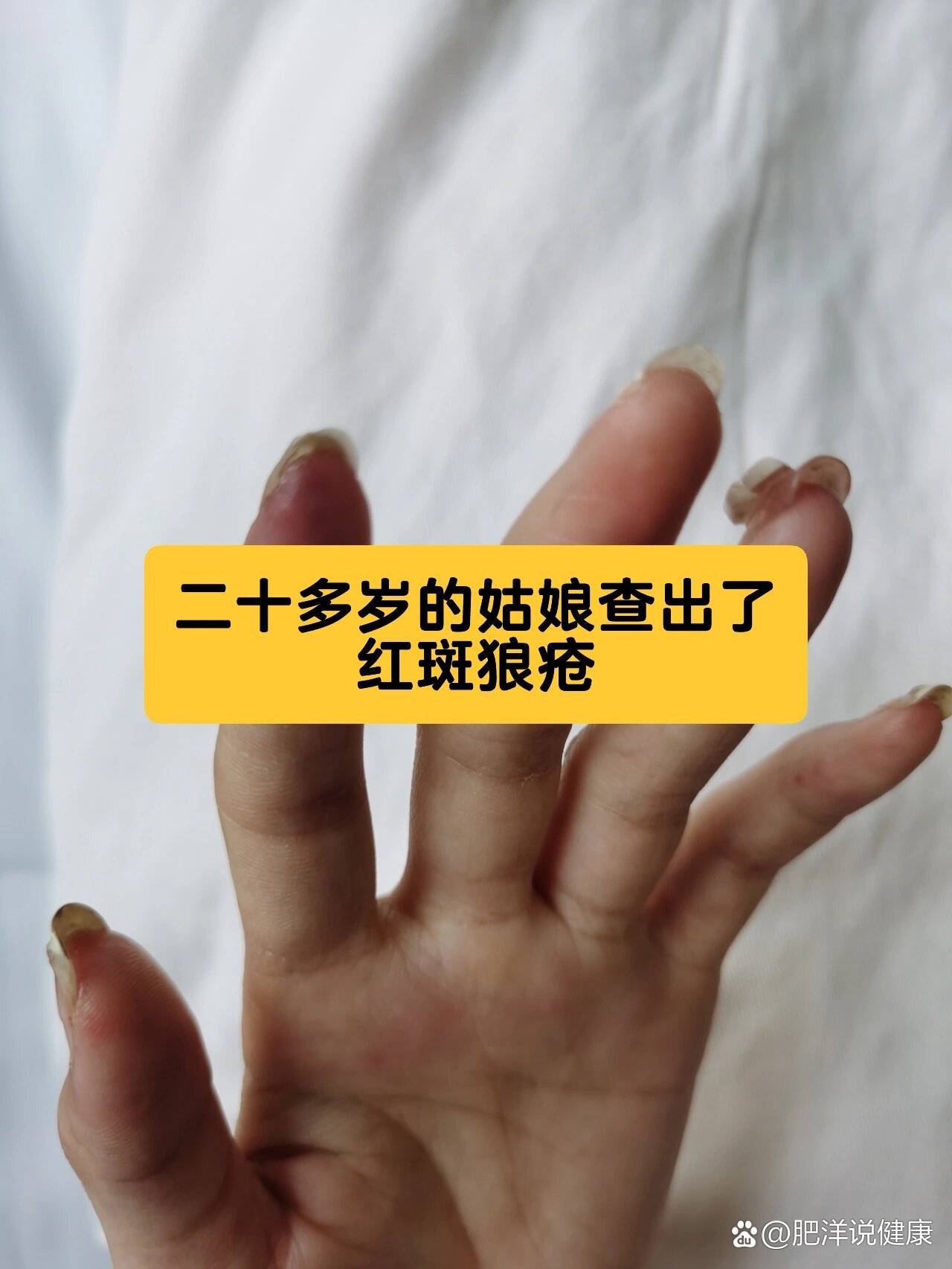 红斑狼疮姑娘的手,指端发青发紫