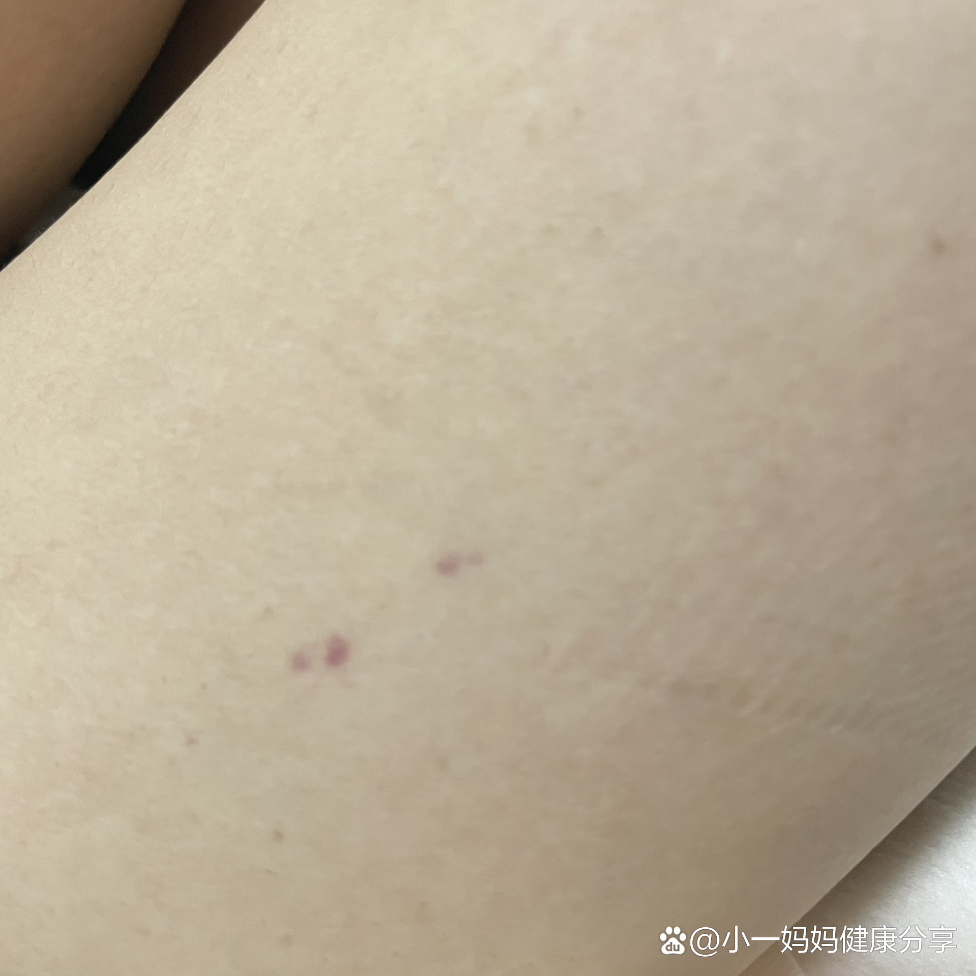 大腿上长了这种红紫色的印子不知道是什么
