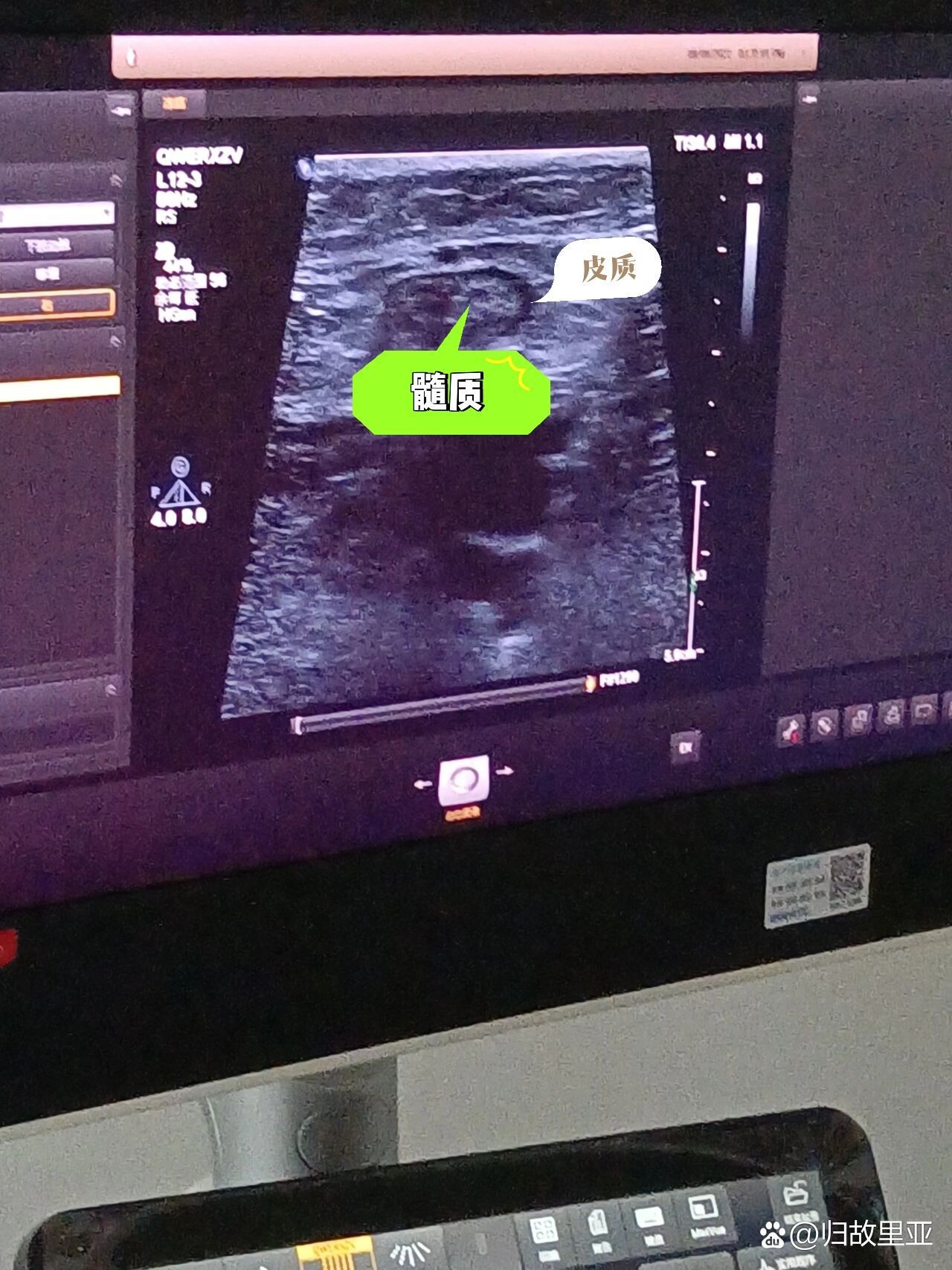 腹股沟淋巴结肿大(糊图版)