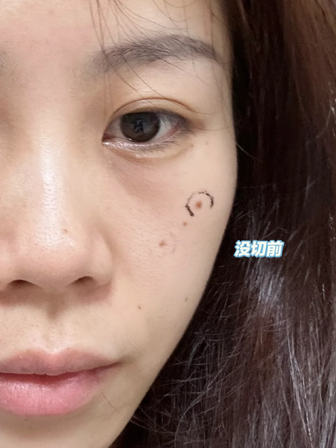 点痣复发后