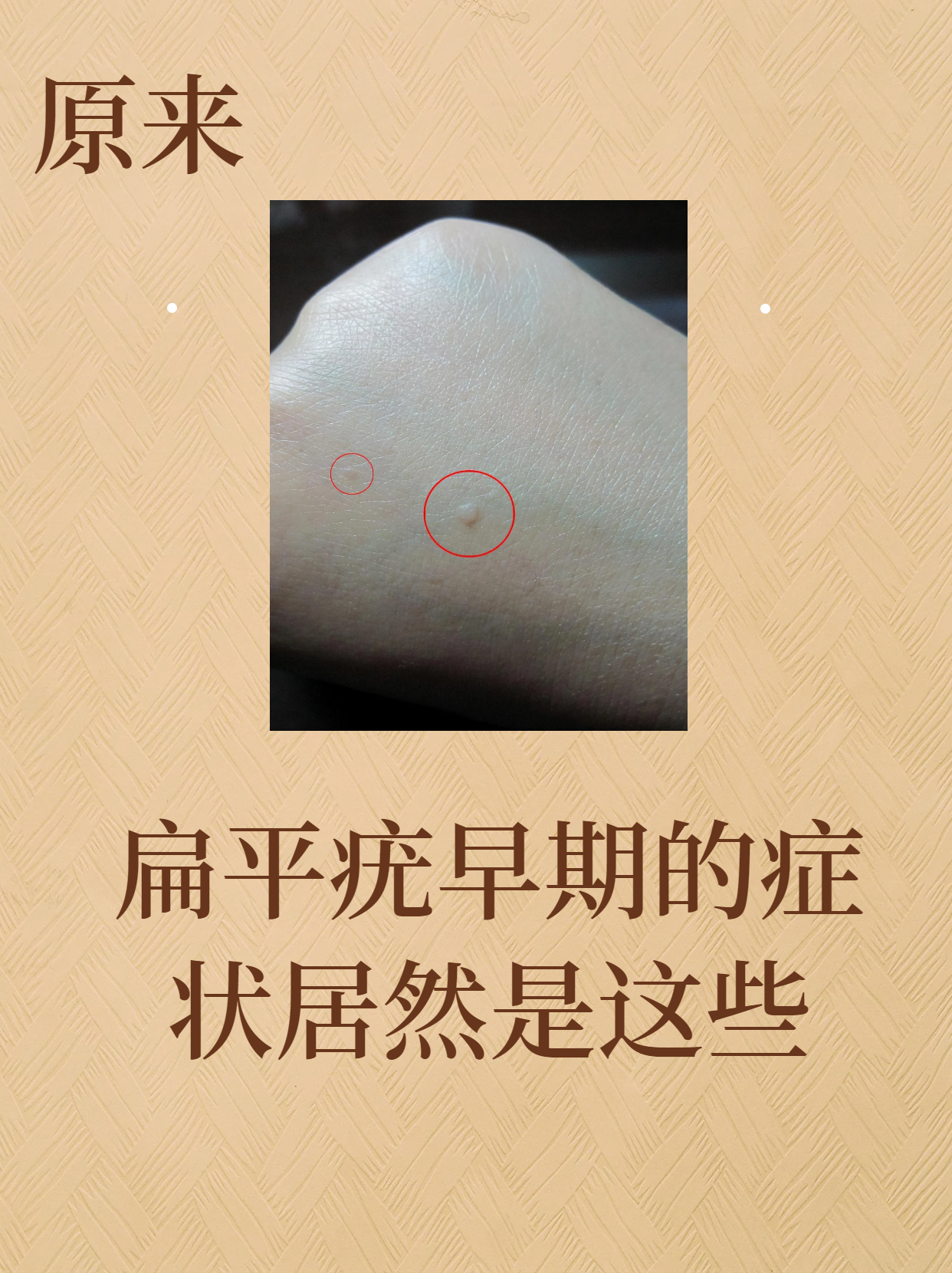 原来,扁平疣早期的症状居然是这些