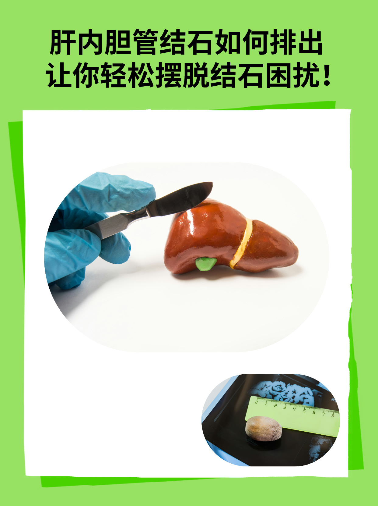肝内胆管结石如何排出?让你轻松摆脱结石困扰!