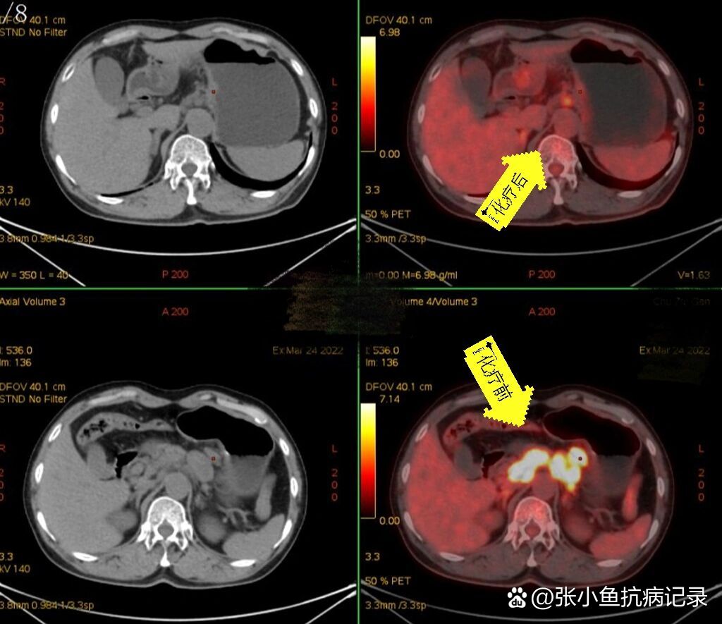 一例晚期胃癌成功治疗的分享