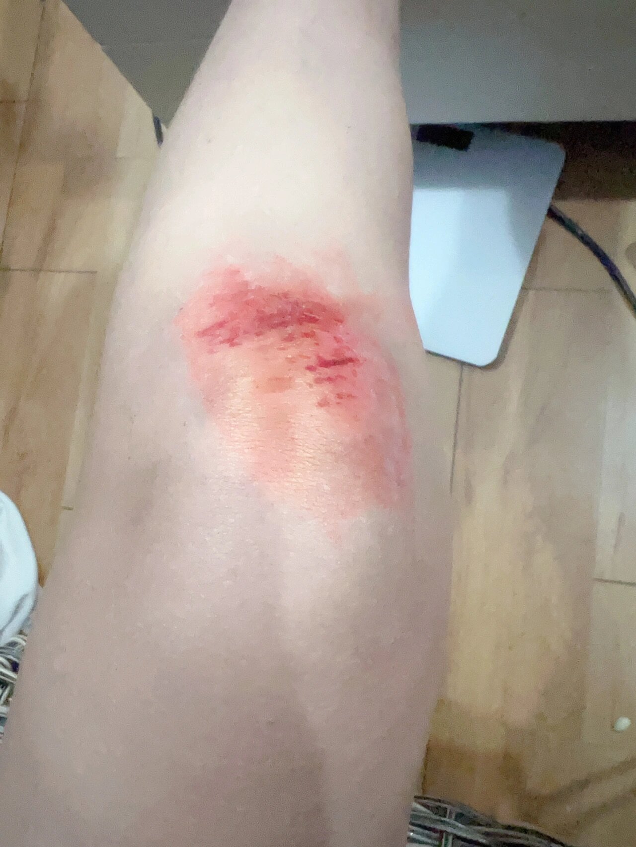 为什么骑车每次摔了都是膝盖破😭