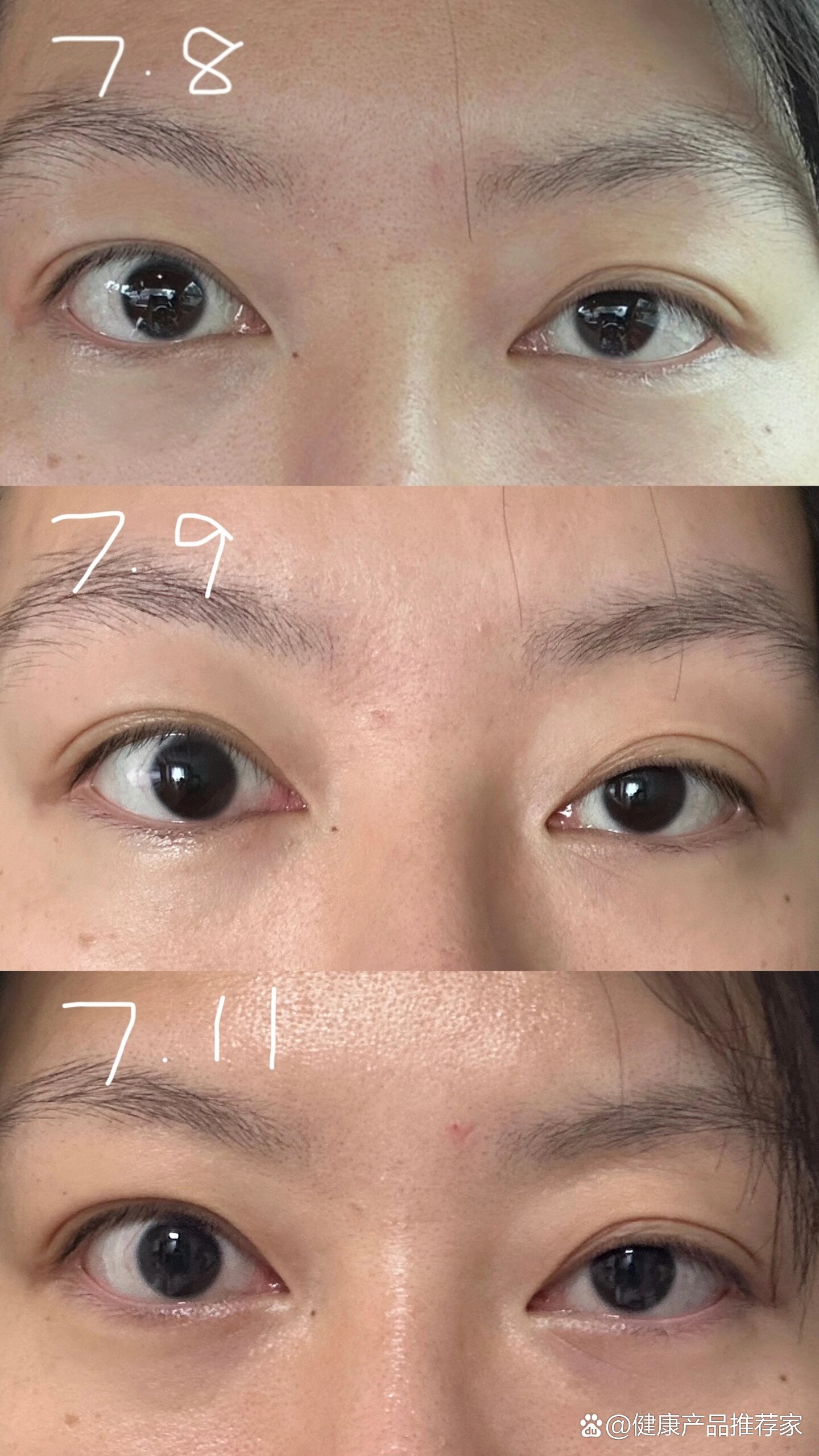 甲亢大小眼注射曲安奈德分享