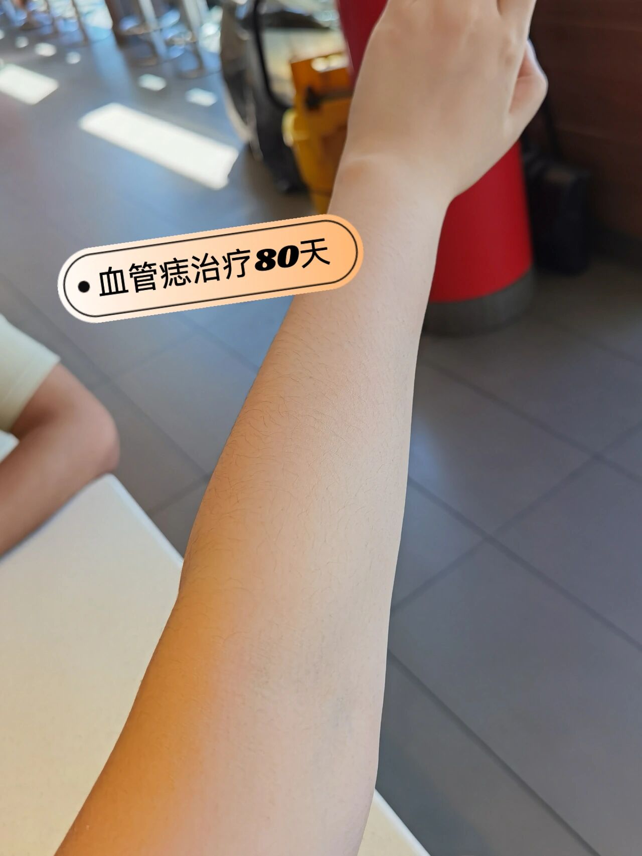 小红点血管痣