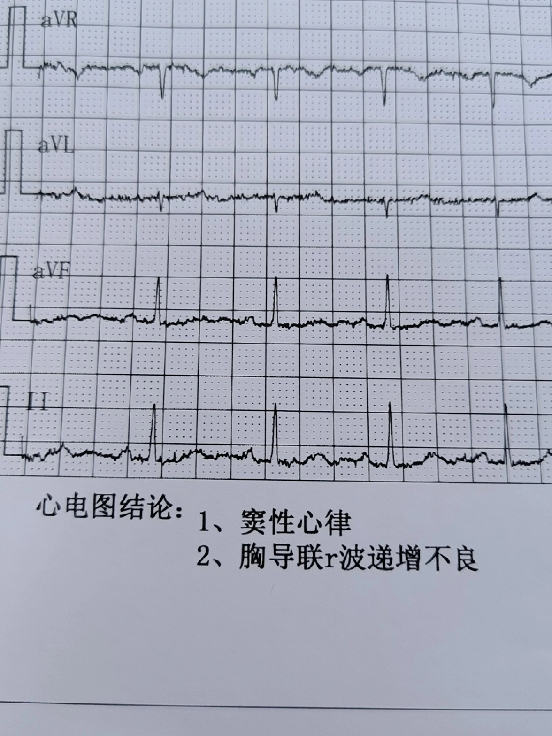 胸透心电图图片