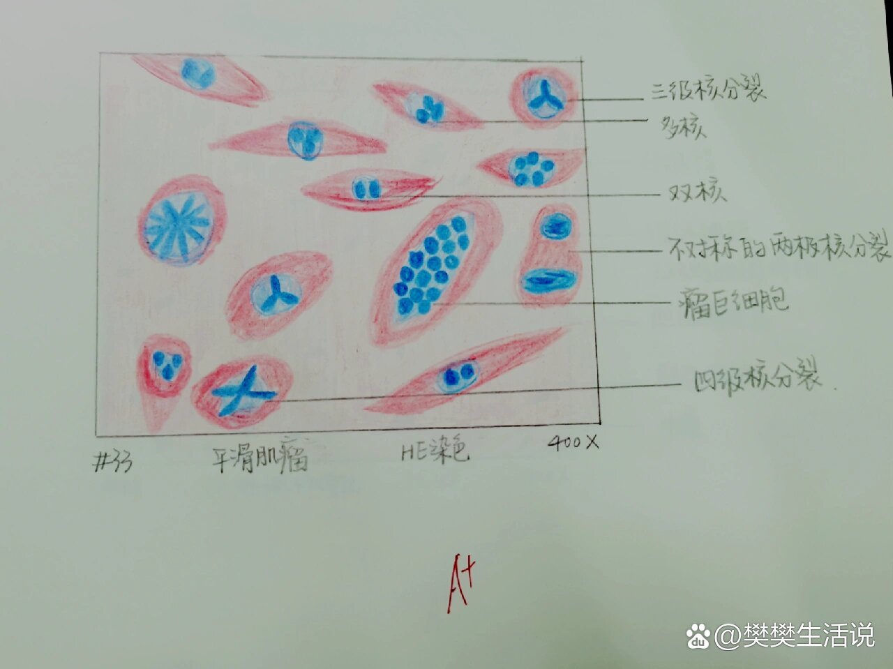 动脉粥样硬化红蓝铅笔图片