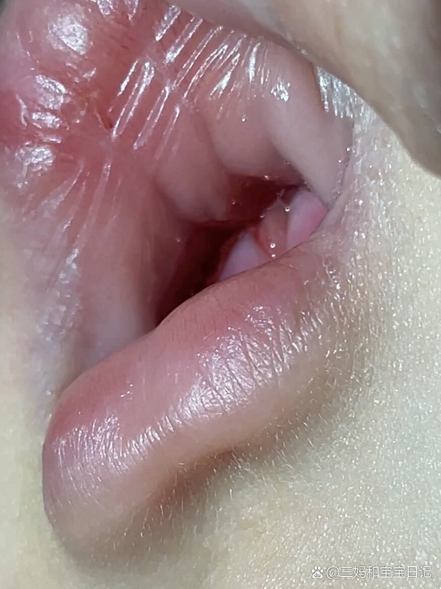 有人知道这是宝宝上唇系带断了吗?
