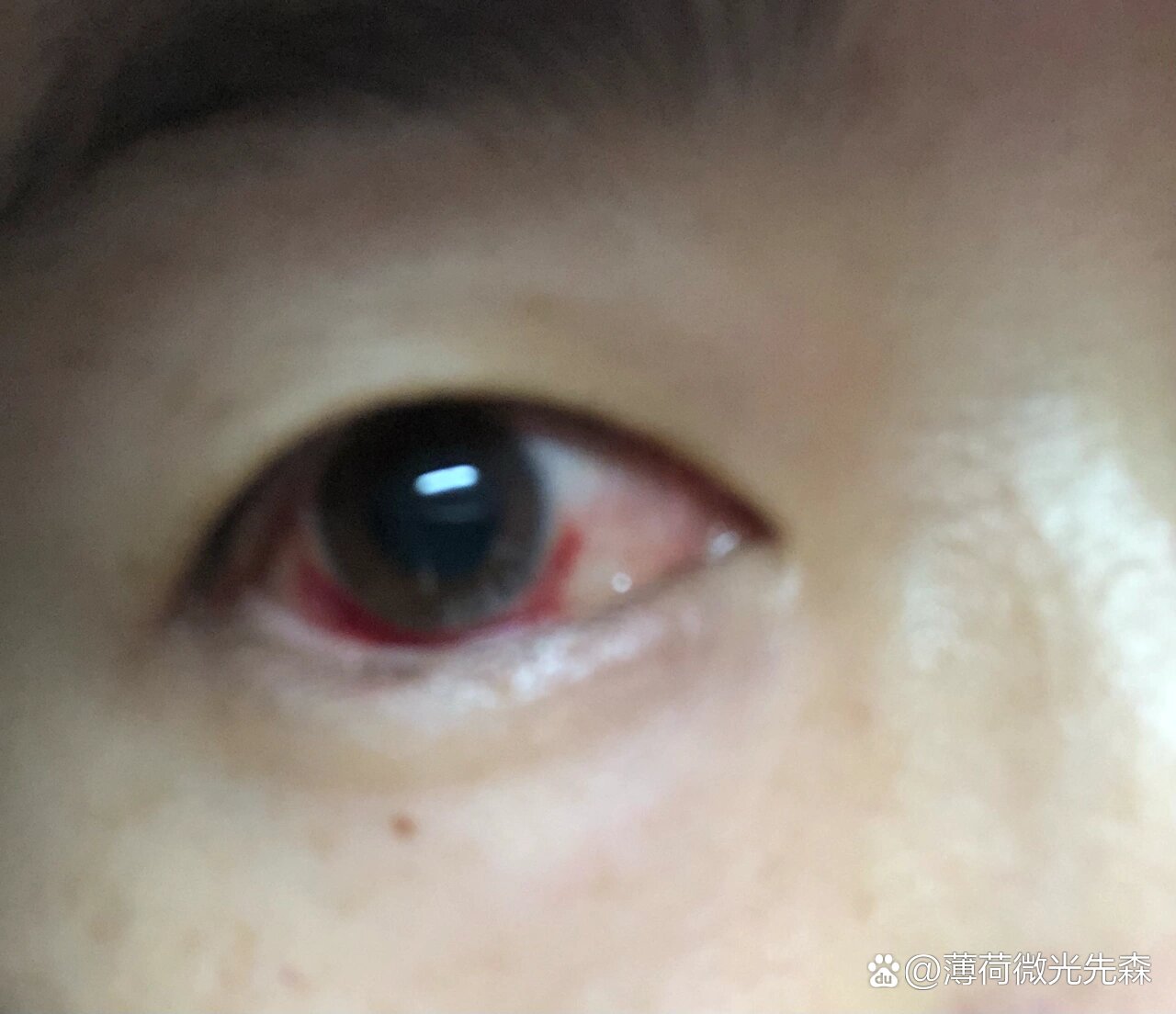 第一次得虹膜炎,第一次经历眼睛扎针