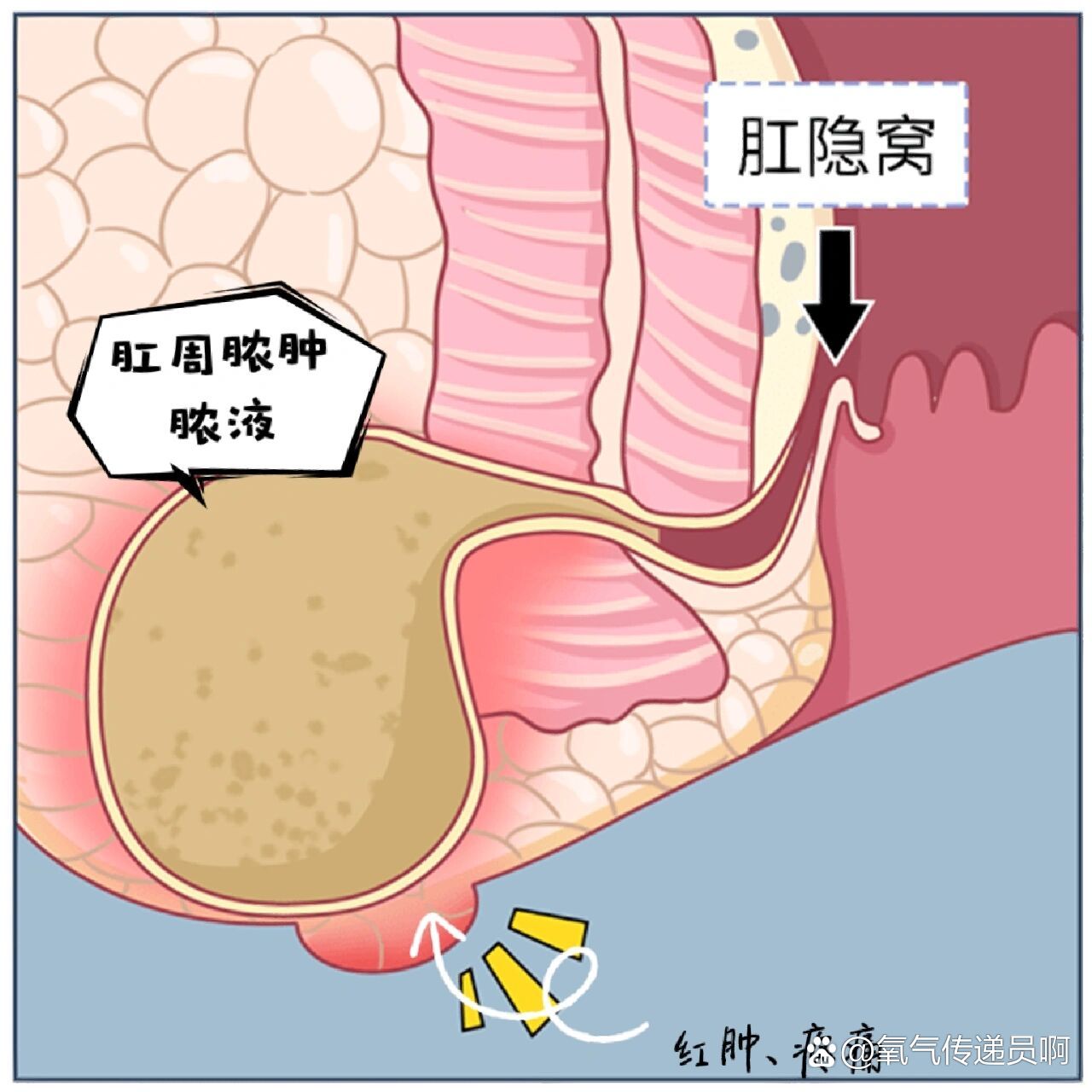 肛瘘卡通图片