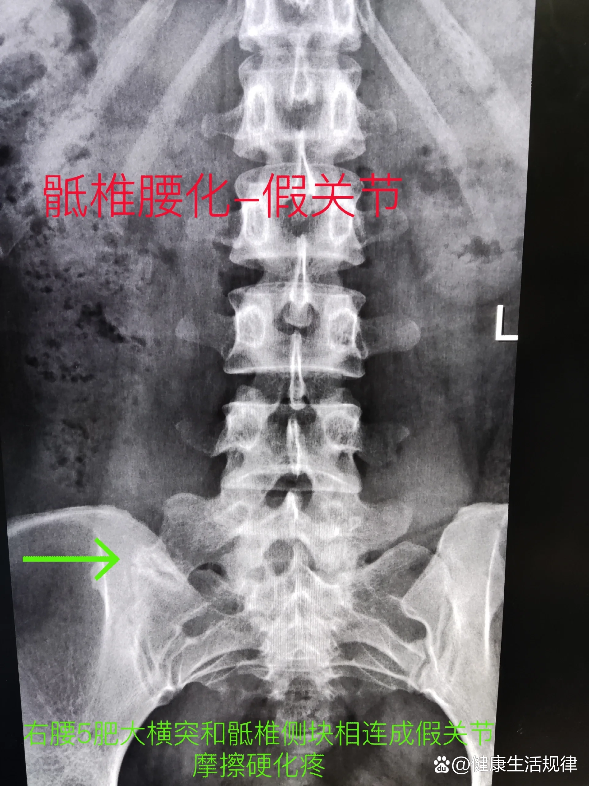 骶椎腰化假关节and叉状肋
