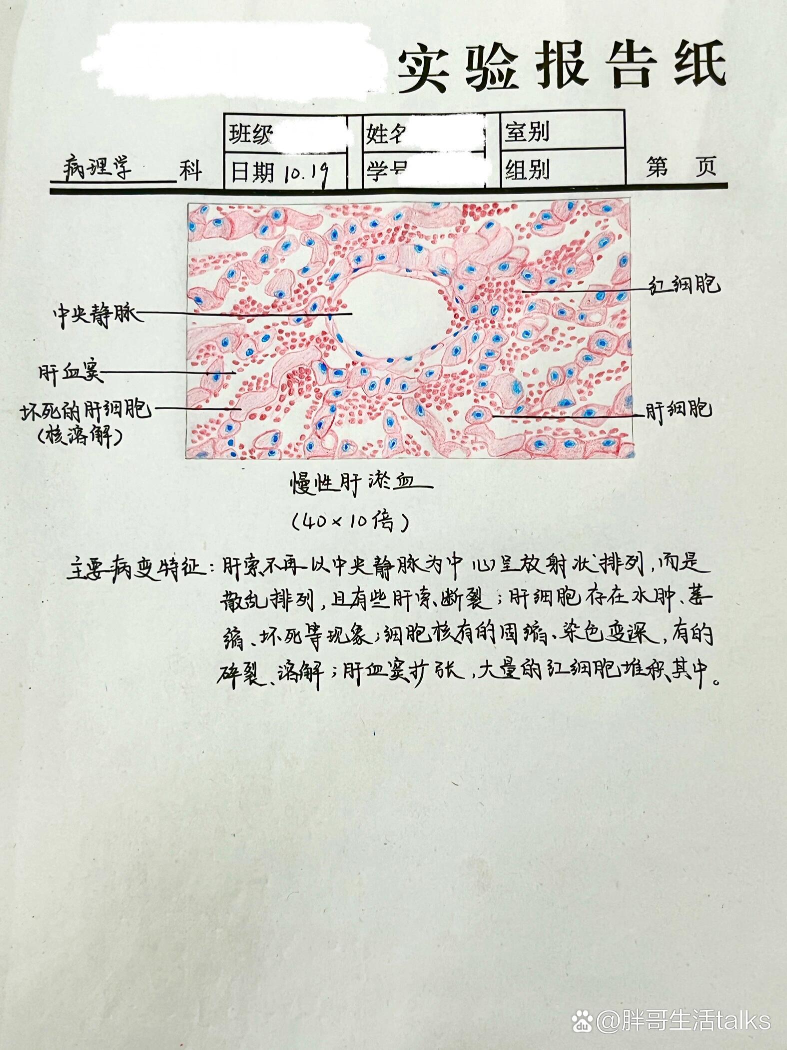 肝淤血图片带标注图片