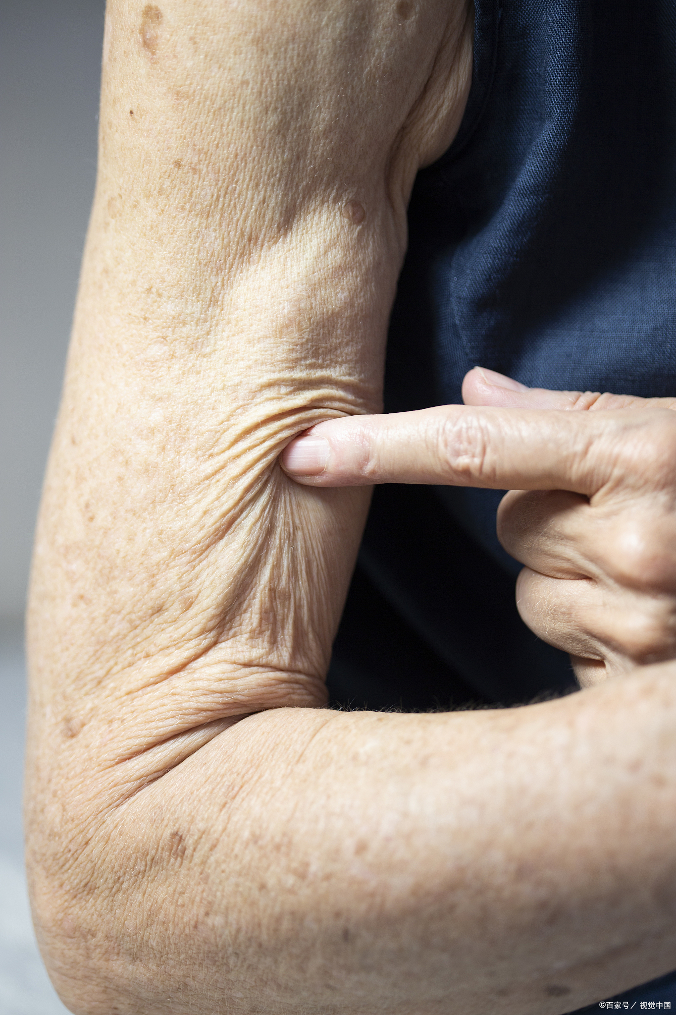 手臂拜拜肉松弛怎么紧致快?