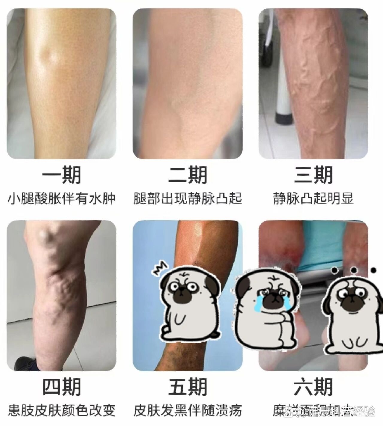有静脉曲张腿怎么办?