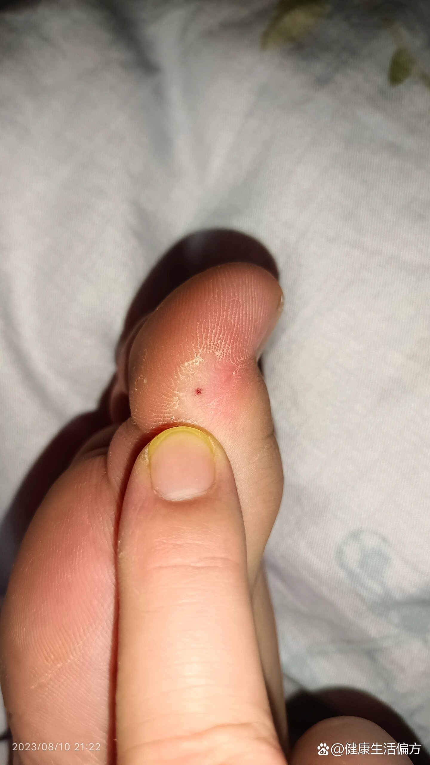 从小大脚拇指外侧就起老茧子,不痛不痒,剪到最里面就是图二那种.