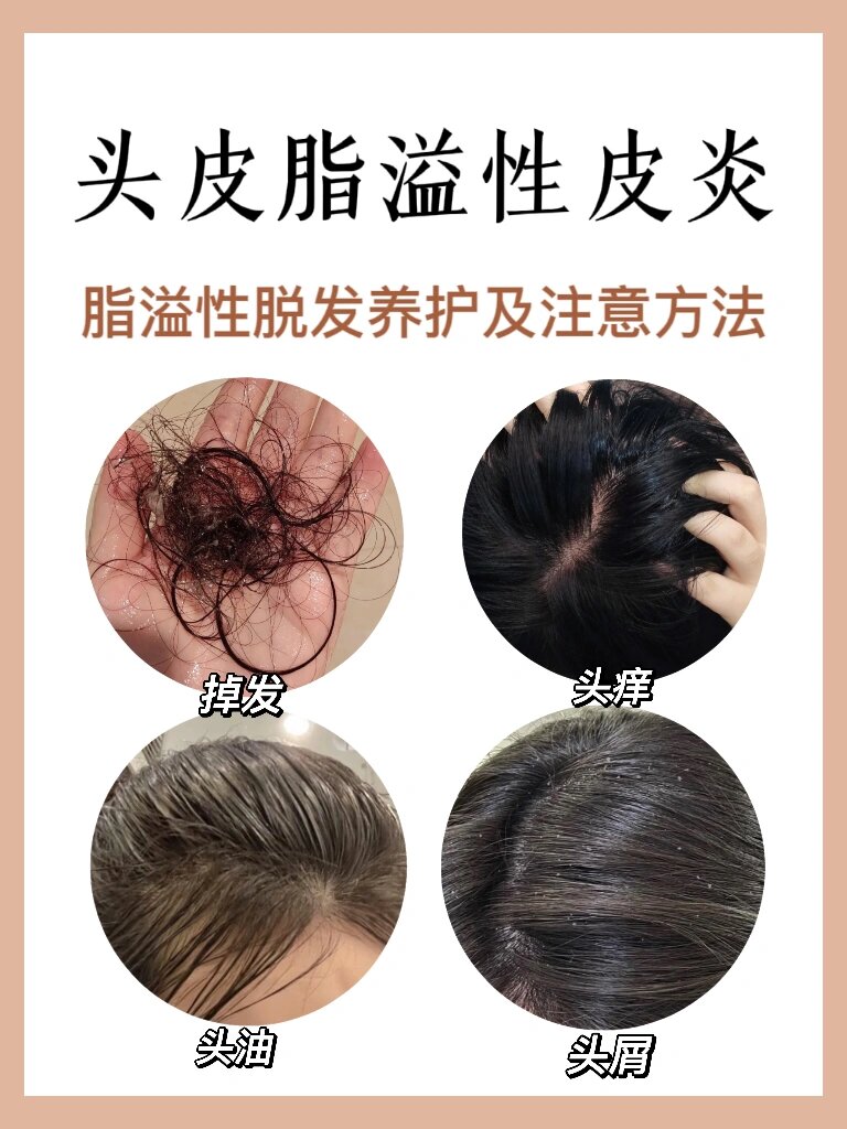 脂溢性脱发如何预防和养护?