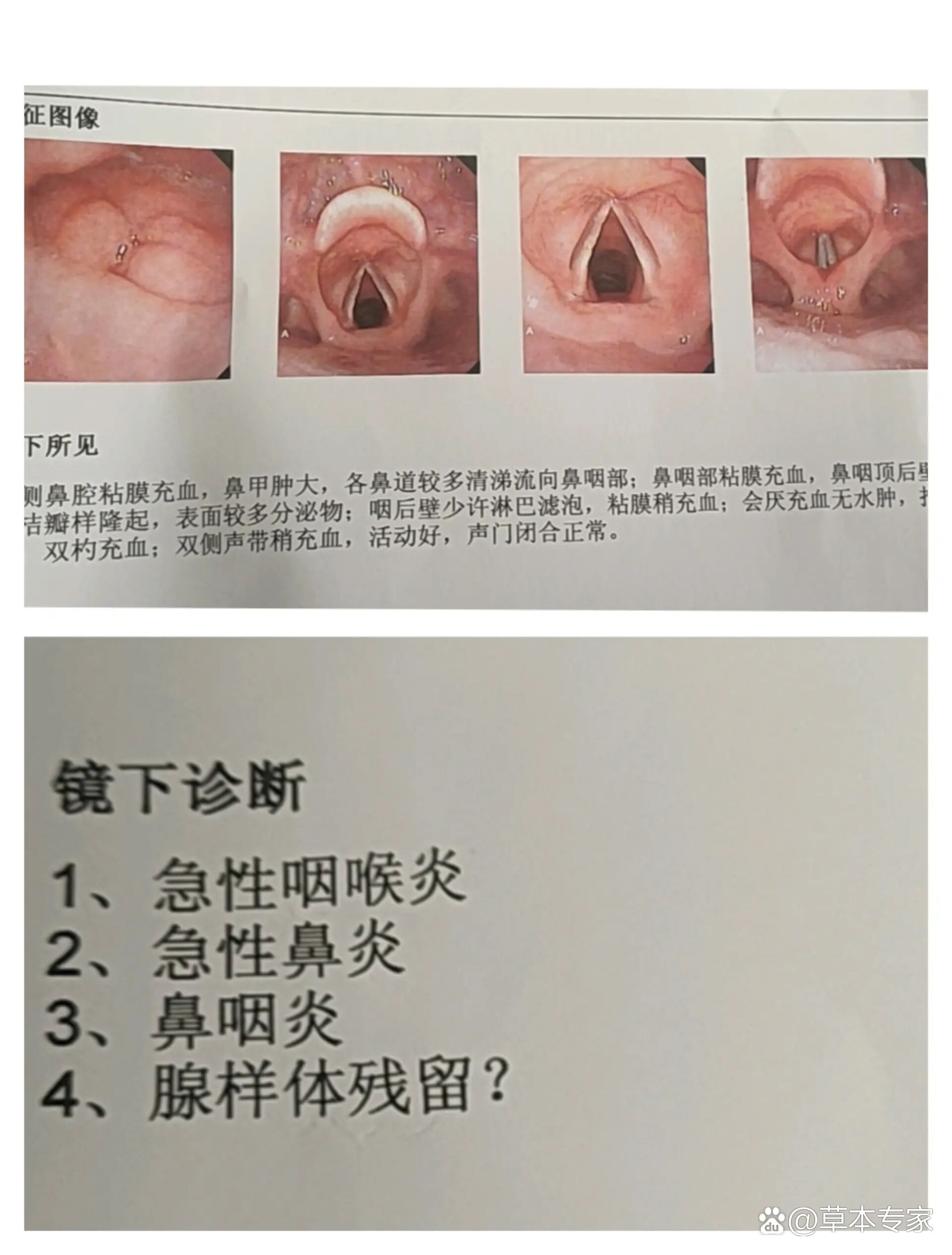 会厌在咽喉的哪个位置图片