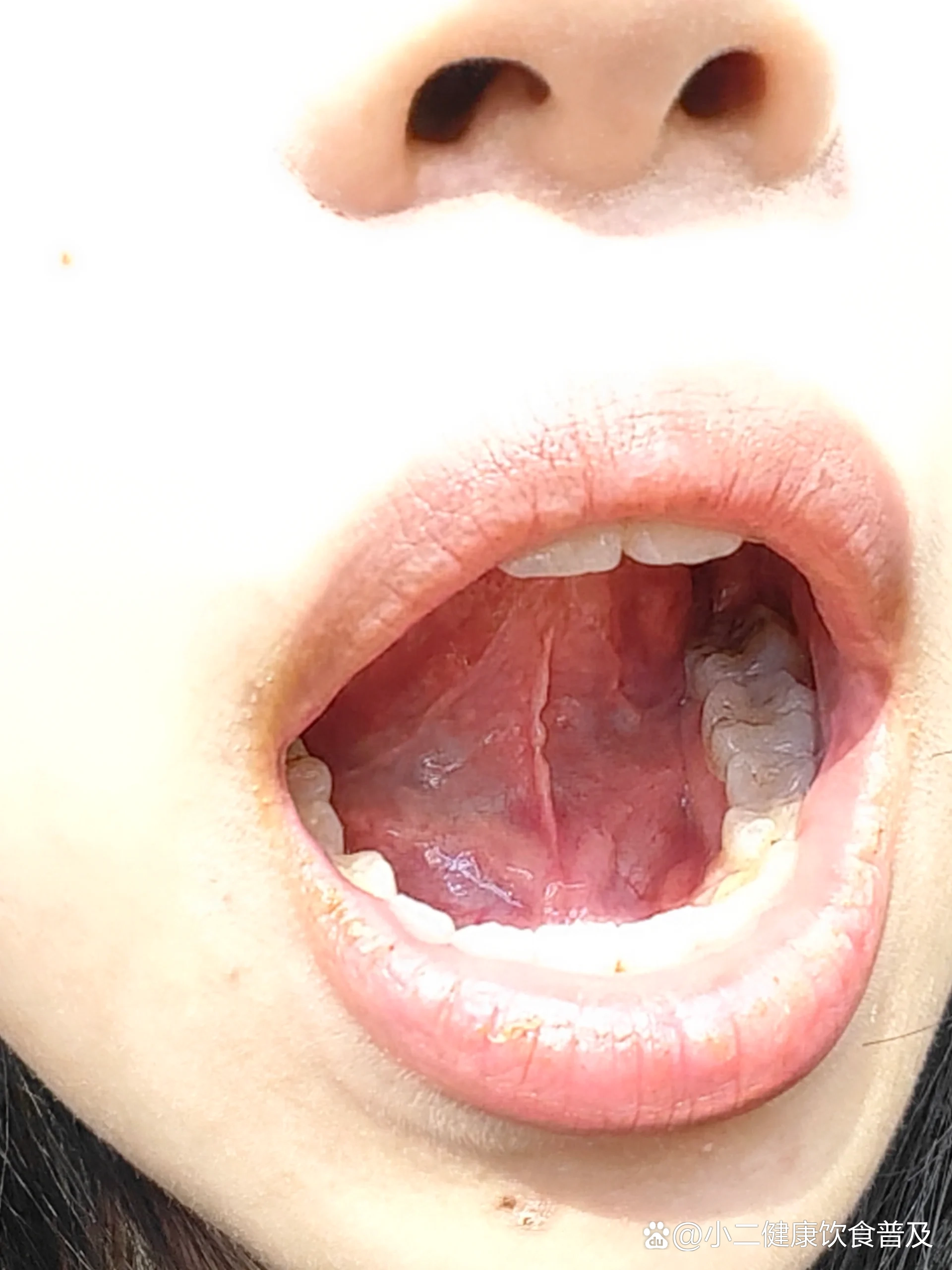 舌系带肿怎么回事