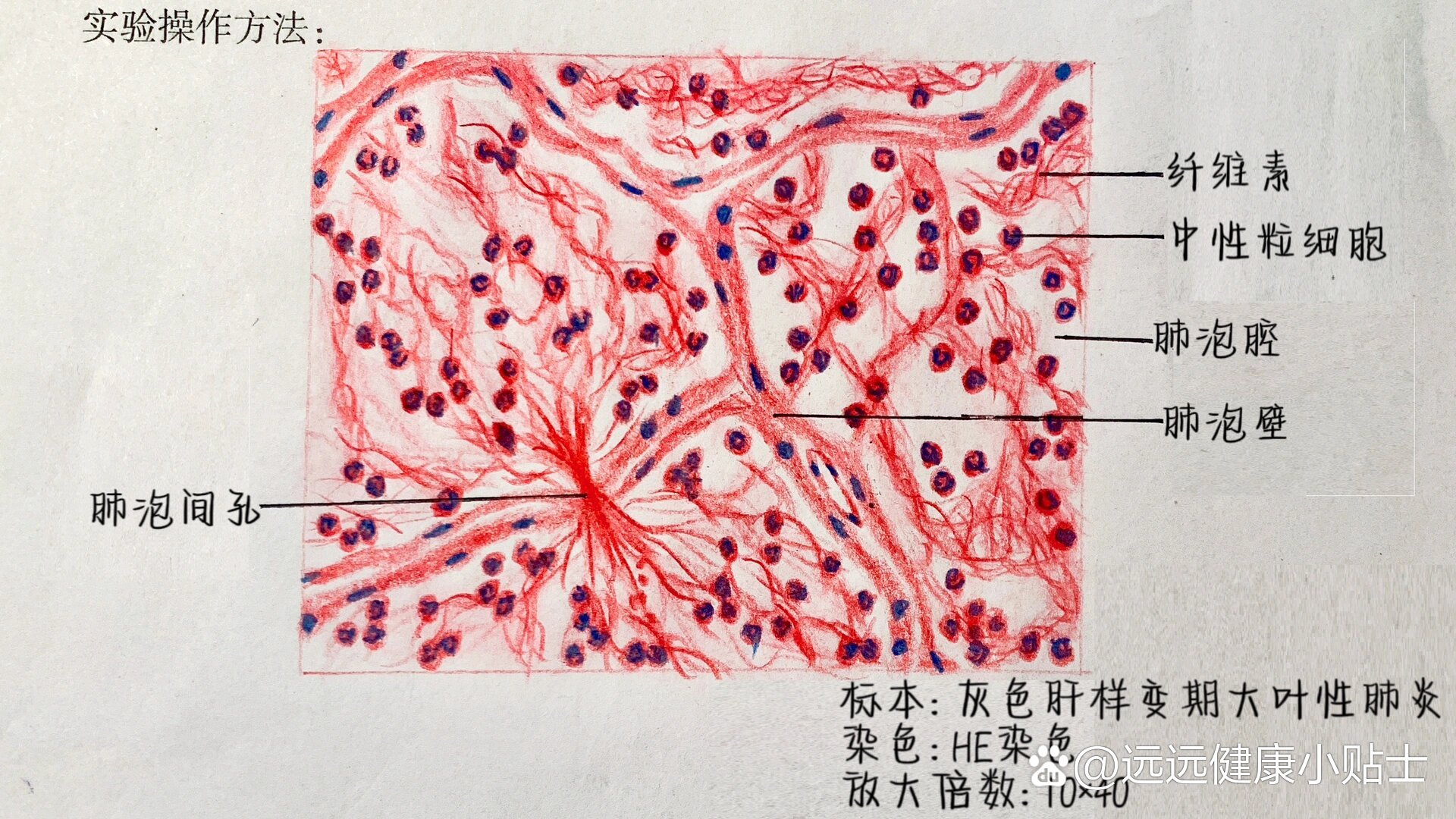 纤维素网中有大量中性粒细胞