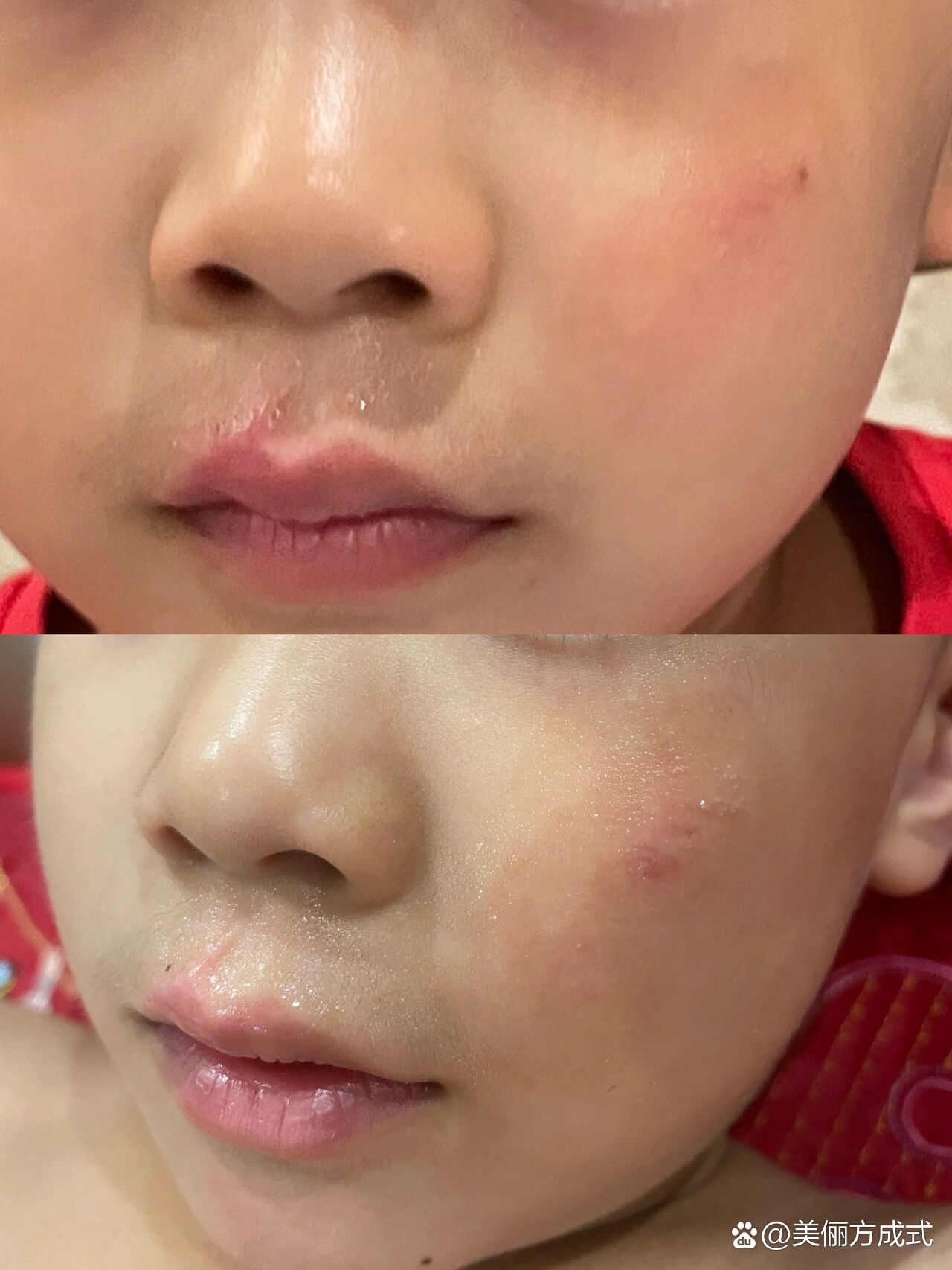 把孩子摔了,无比心疼,恢复两个月多点了,脸上和人中还有明显疤痕,特别