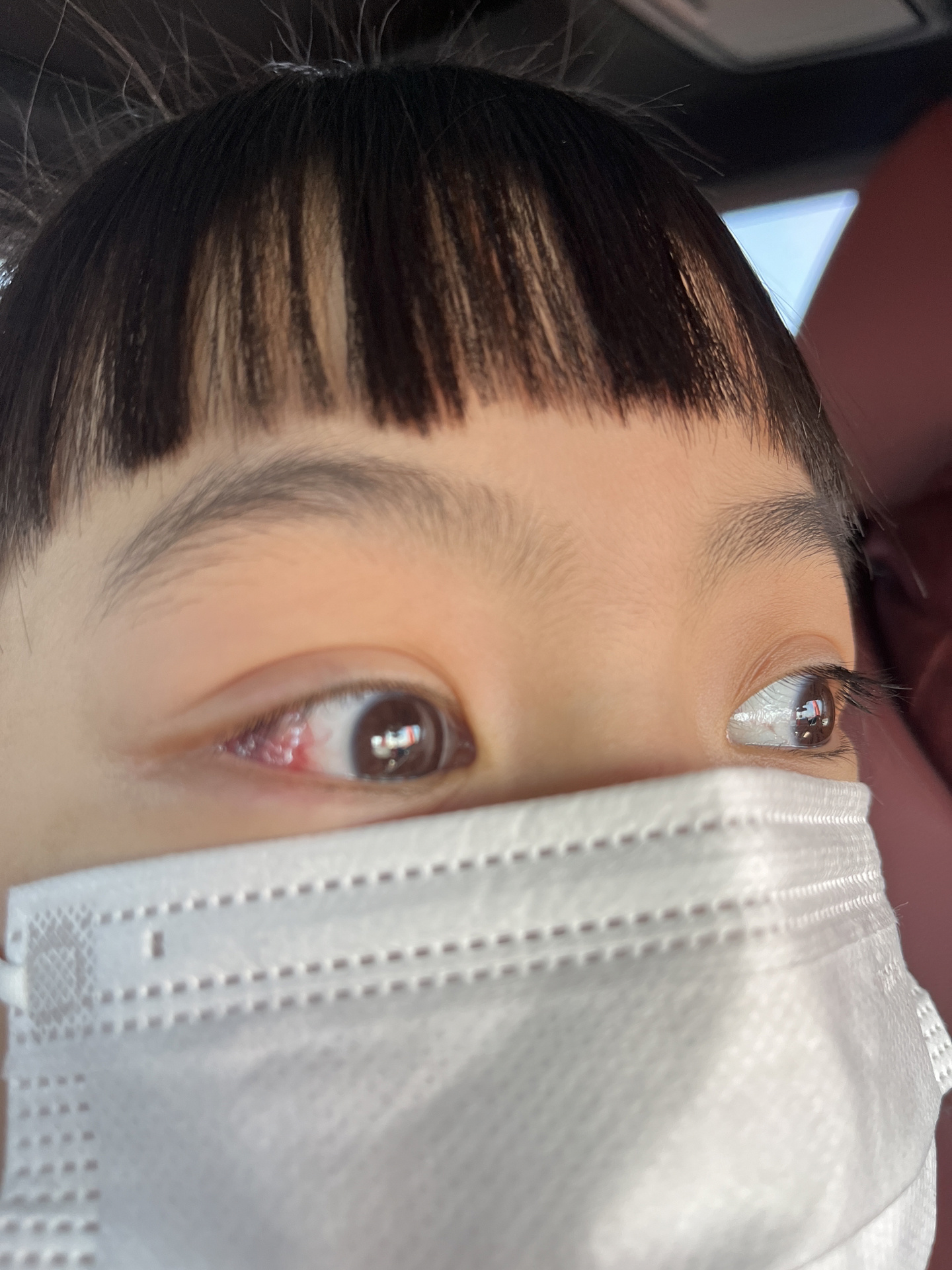 儿童斜视手术术后13天