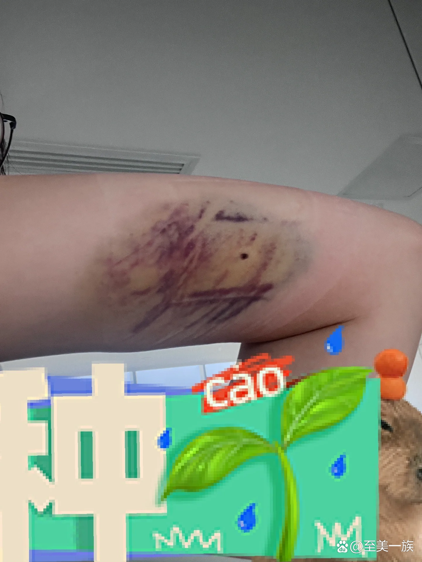 皮埋四天后的手臂