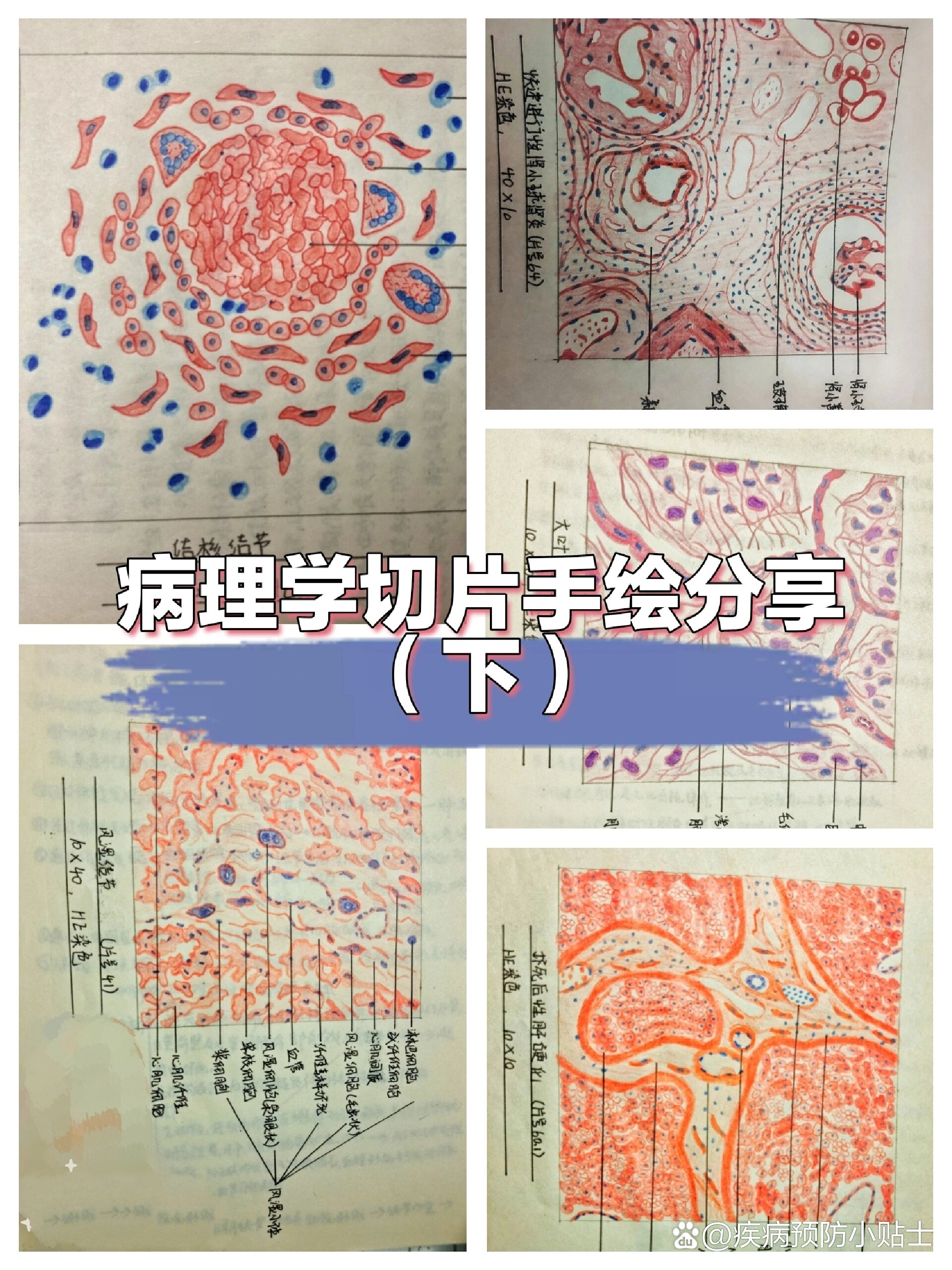 肺脓肿病理切片绘图图片